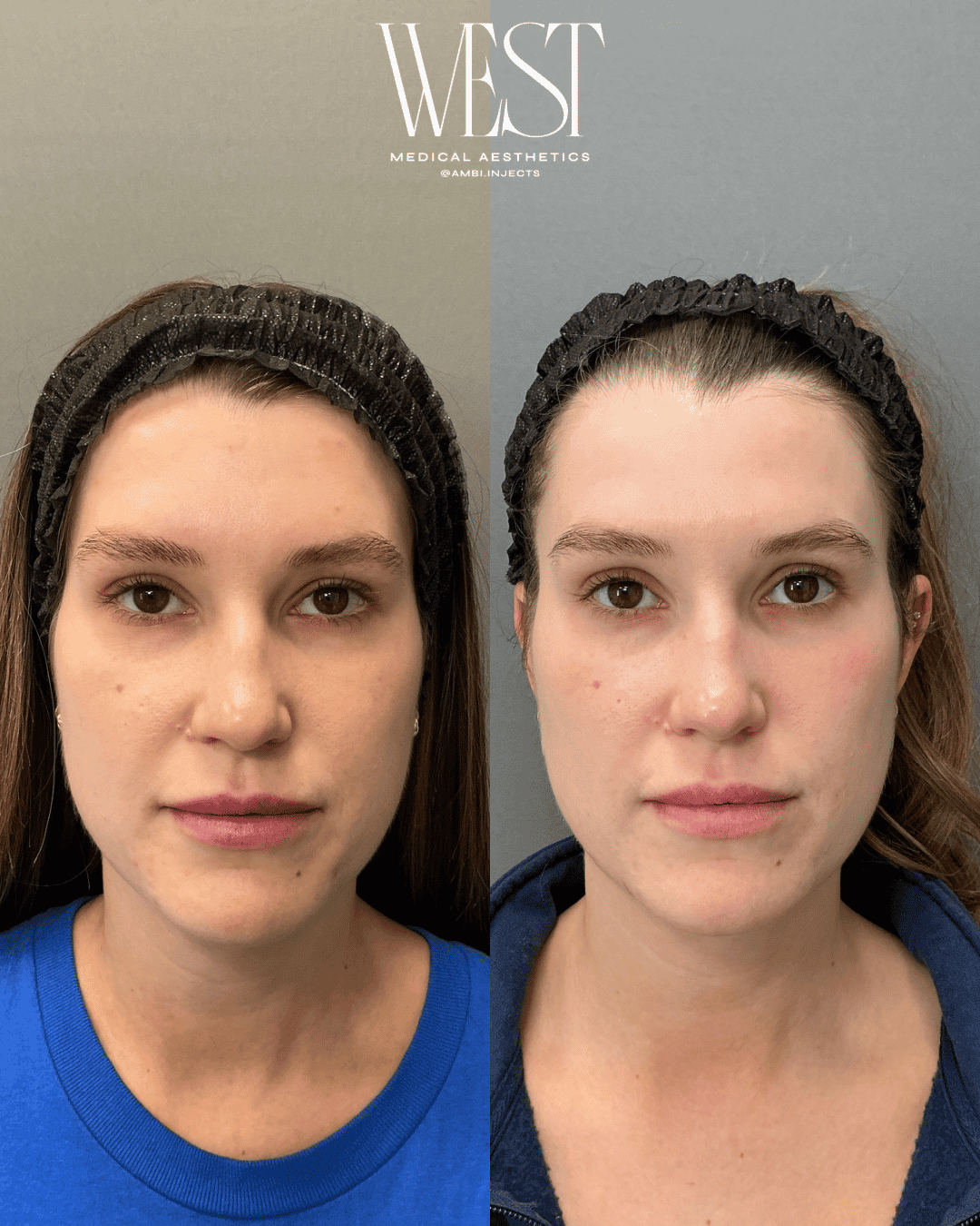 BBL Heroic Laser skin treatment in okc