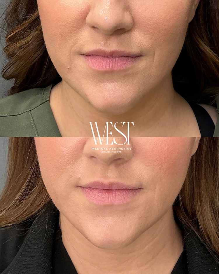 Halo Laser skin treatment in oklahoma city