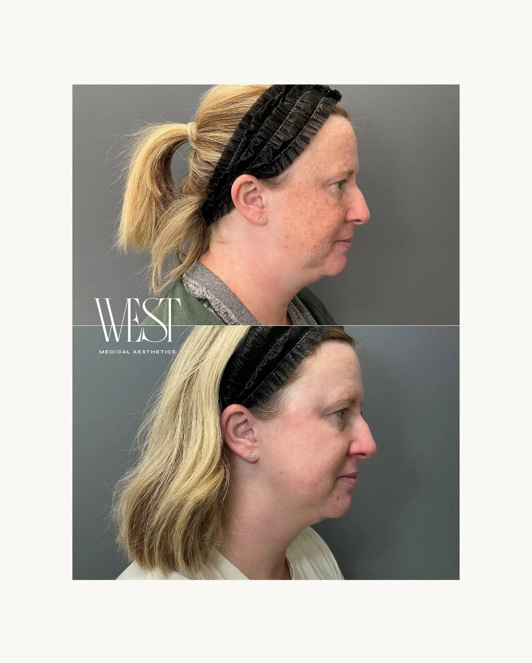 transformation loading&hellip; ✨

@astheticnurse_emily started by prepping the skin with a customized ZO Skin Health regimen, then followed with BBL HEROic + MOXI for the ultimate refresh.