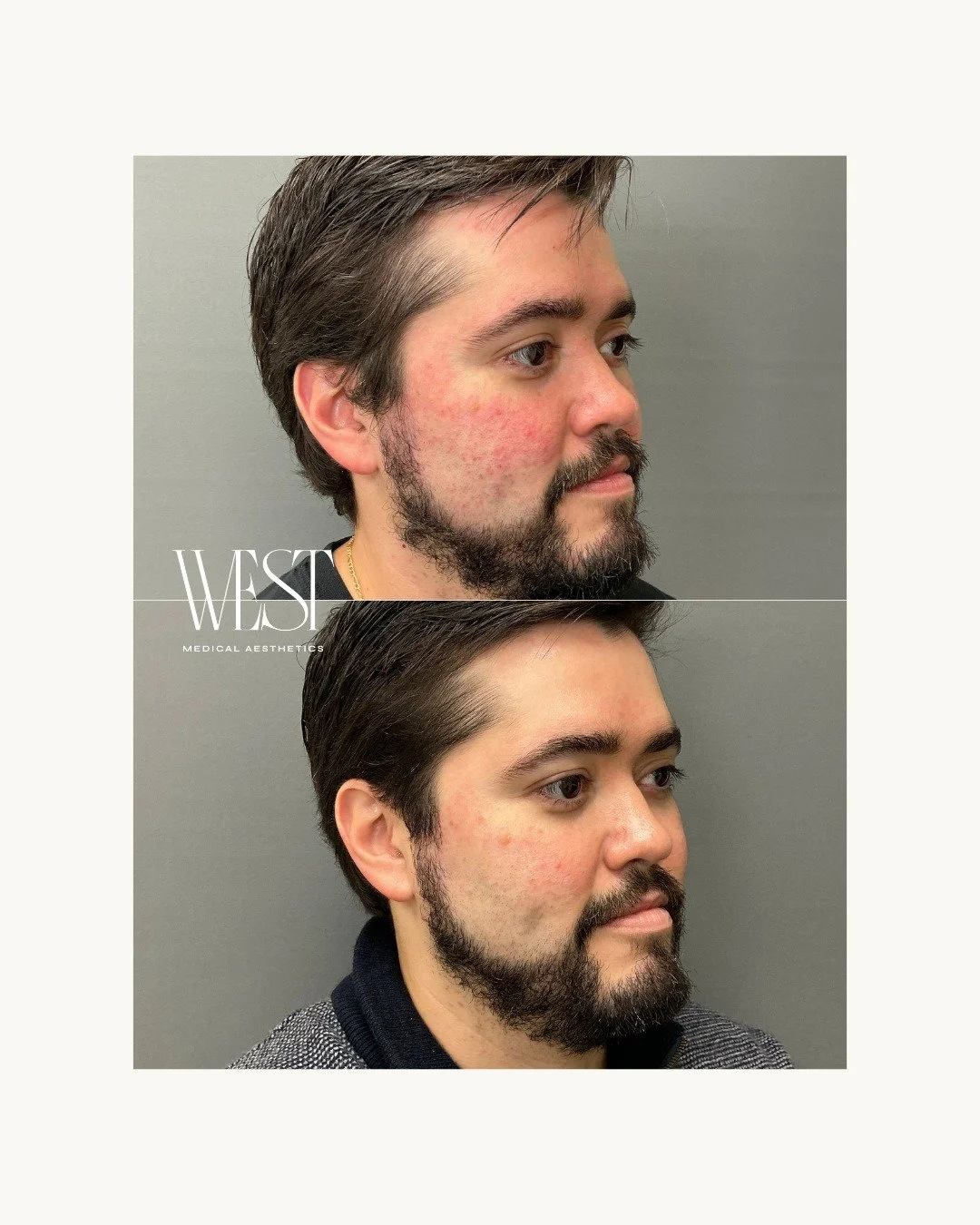 Redness, refined 👏

After just 1 BBL HEROic treatment (with a series of 3 planned) + a customized ZO regimen, we&rsquo;re already seeing a major improvement in his overall skin tone.

He came to Amberlie after watching his wife see beautiful results