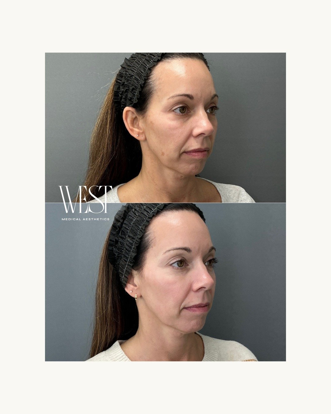 Before + After | BBL HEROic + MOXI 

A beautiful refresh for the face and neck with 1 BBL HEROic + MOXI treatment by @aestheticnurse_emily ✨ 

This combination treatment works to improve overall skin tone and texture while reducing the appearance of 