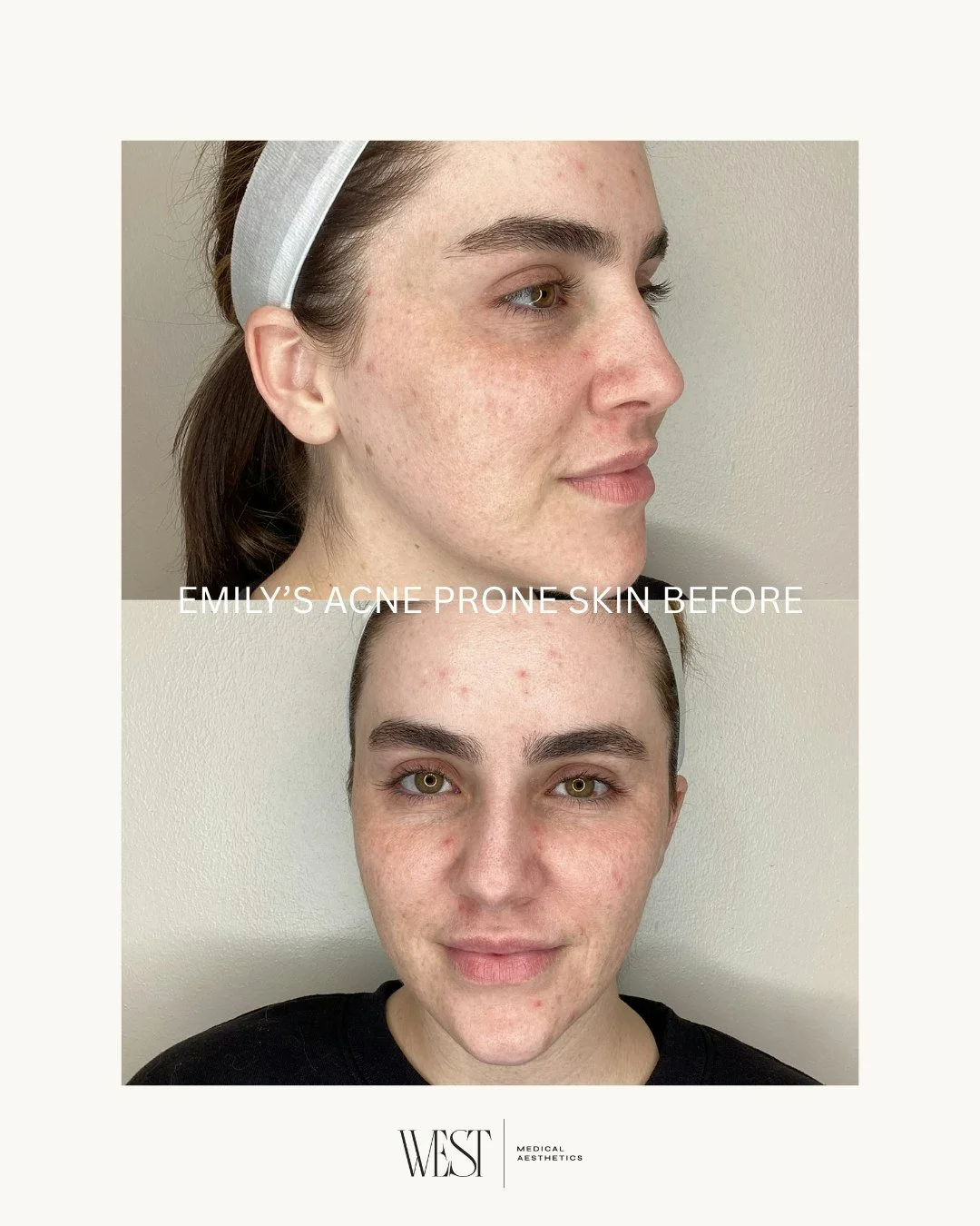 Acne Awareness Month is the perfect reminder that clear skin isn't about finding one miracle product&mdash;it's about finding the right plan for your skin. 🤍

Emily struggled with acne-prone skin for years, and these three changes over the past four