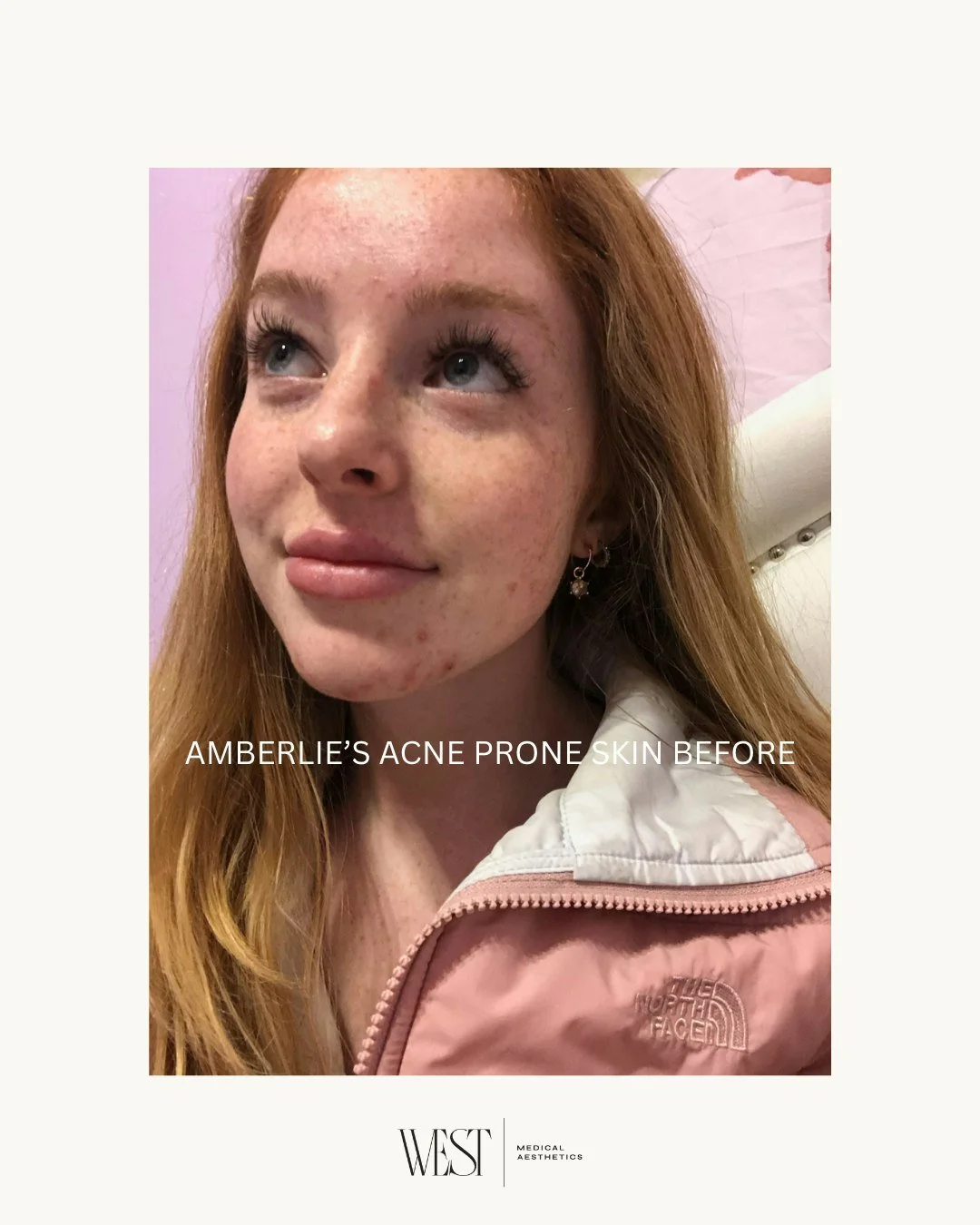 Clear skin doesn't happen overnight. 🤍✨

Amberlie's transformation is the result of consistency&mdash;not a quick fix. Here's what made the biggest difference:

✨ ZO Skin Health acne regimen

✨ Quarterly Forever Clear BBL treatments

✨ SkinPen micro