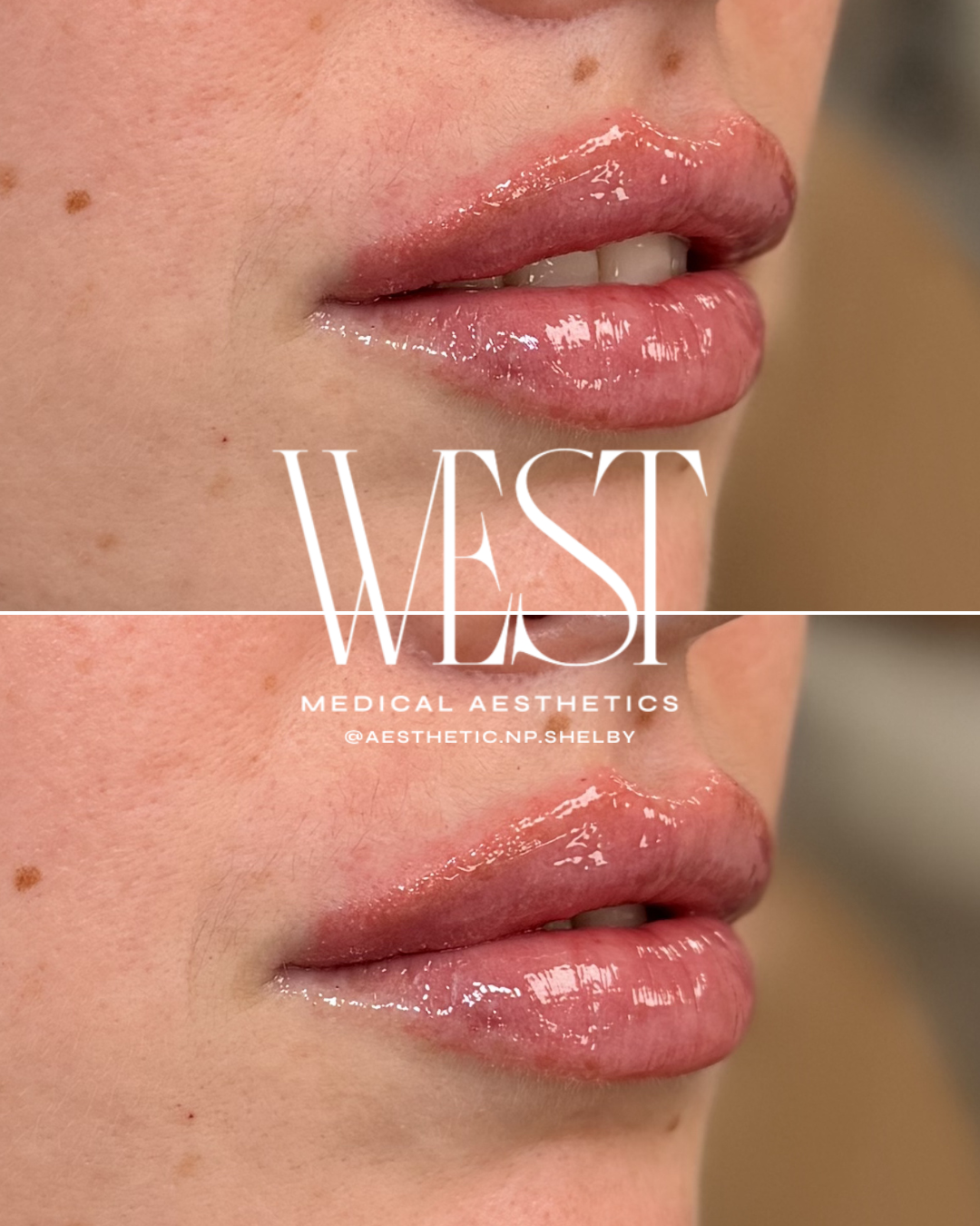 Close-up of a person's lips with glossy pink lipstick, with the text 'WEST Medical Aesthetics @aesthetic.np.shelby' overlaying the image.