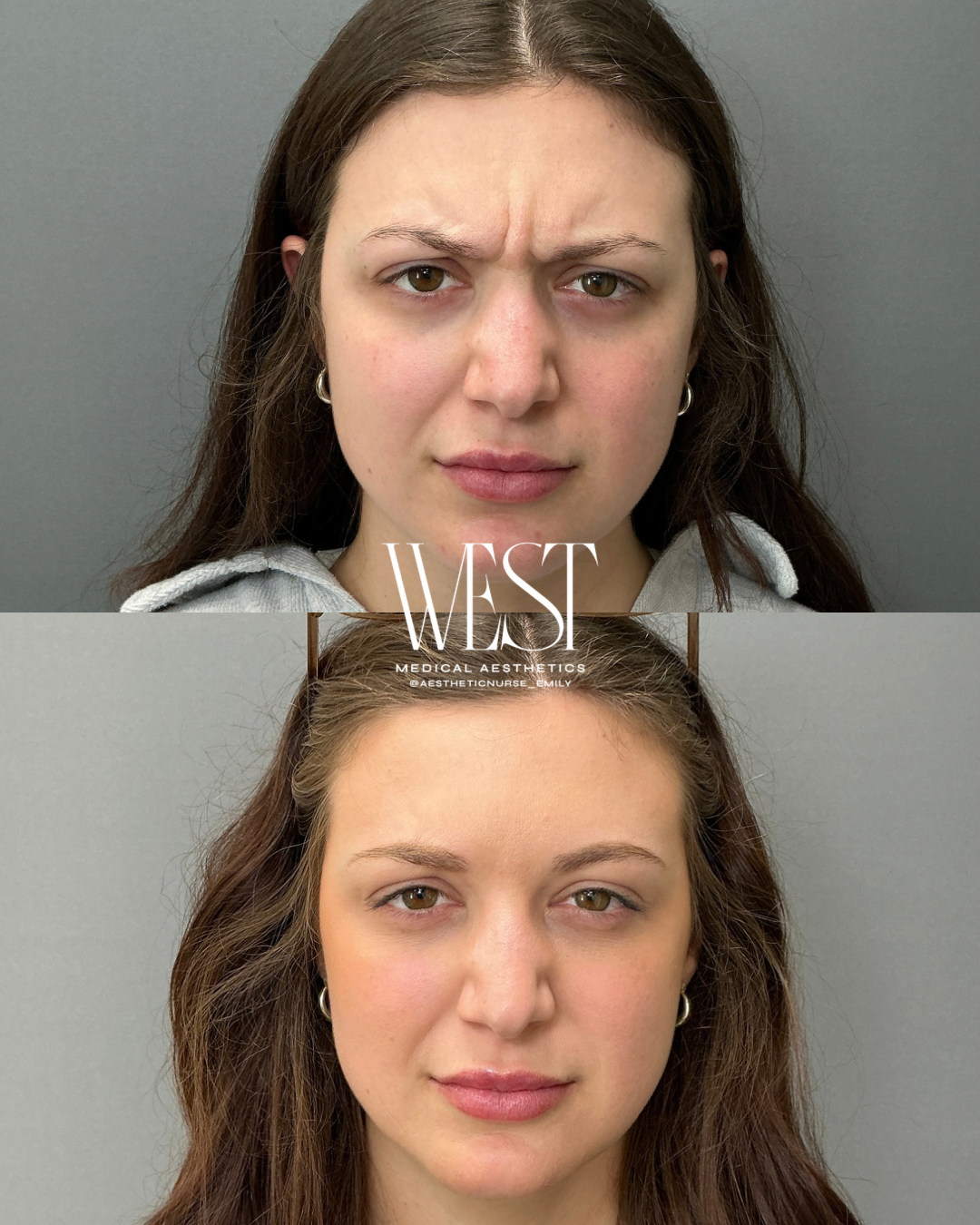 Before and after photos of a woman showing facial changes after a cosmetic procedure, with the logo 'WEST Medical Aesthetics' across the middle.