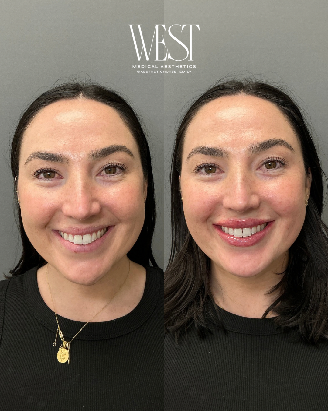 A side-by-side comparison of a woman before and after cosmetic treatment, smiling in both images, with a neutral gray background, black top, and minimal jewelry.