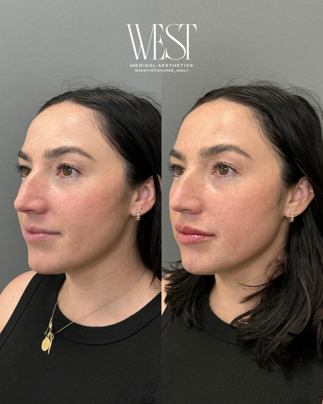 Side-by-side comparison photo of a woman's face before and after cosmetic treatment, showing improved skin texture and gloss.