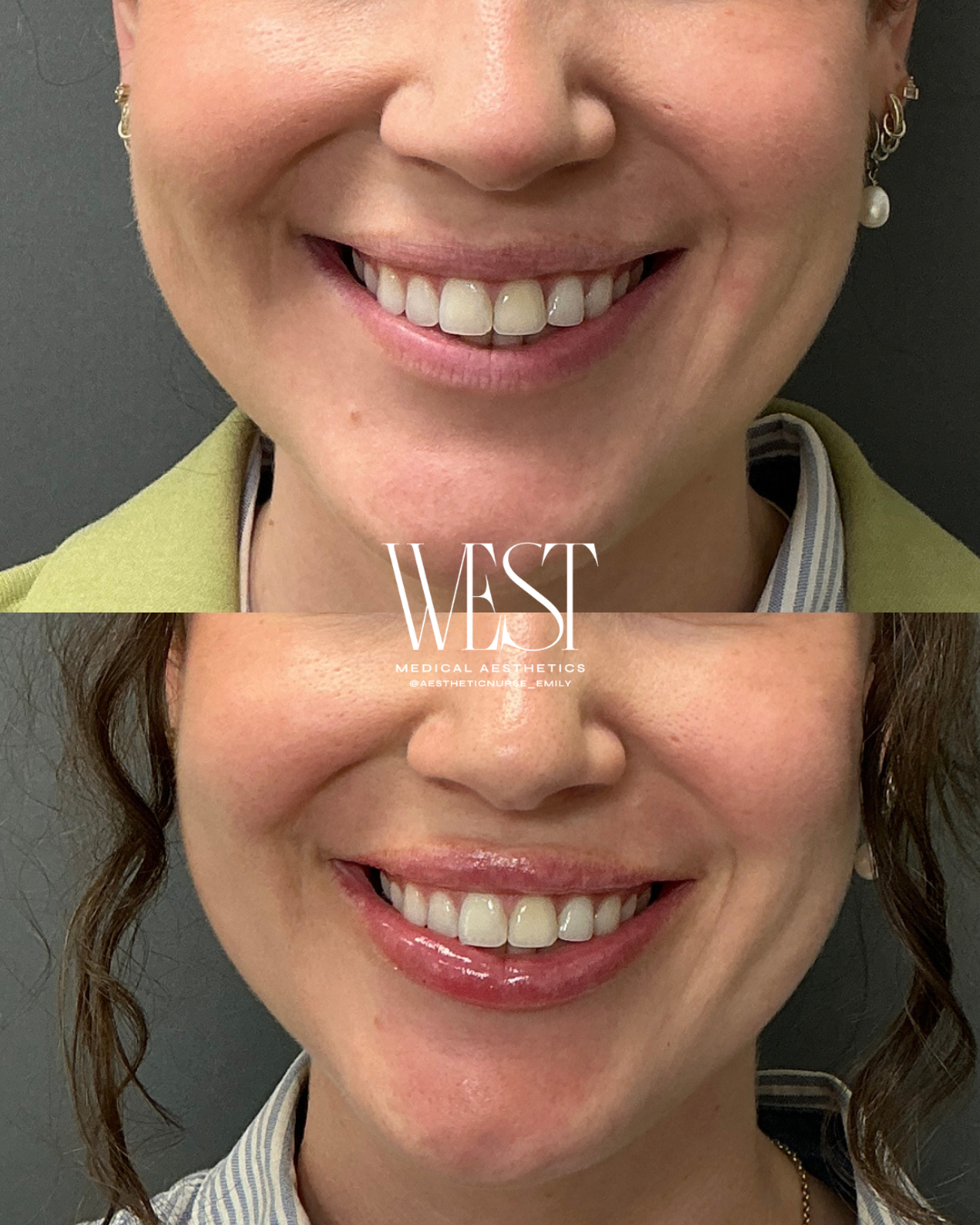 Before and after images showing a woman's smile, highlighting dental improvements, with the logo 'WEST Medical Aesthetics' in the center.
