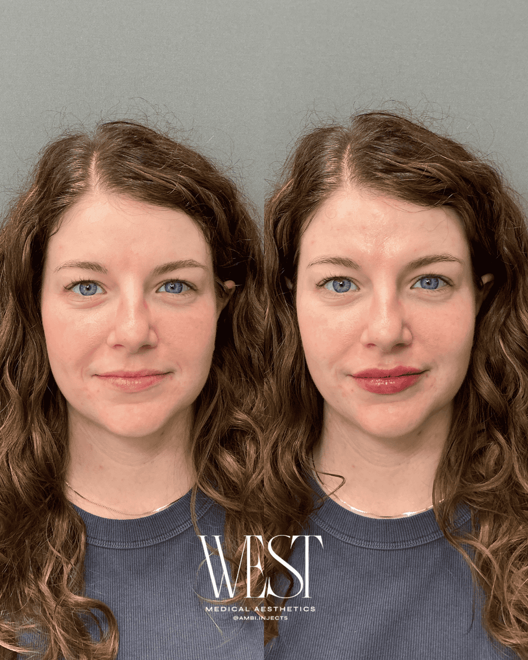 lip filler in oklahoma city