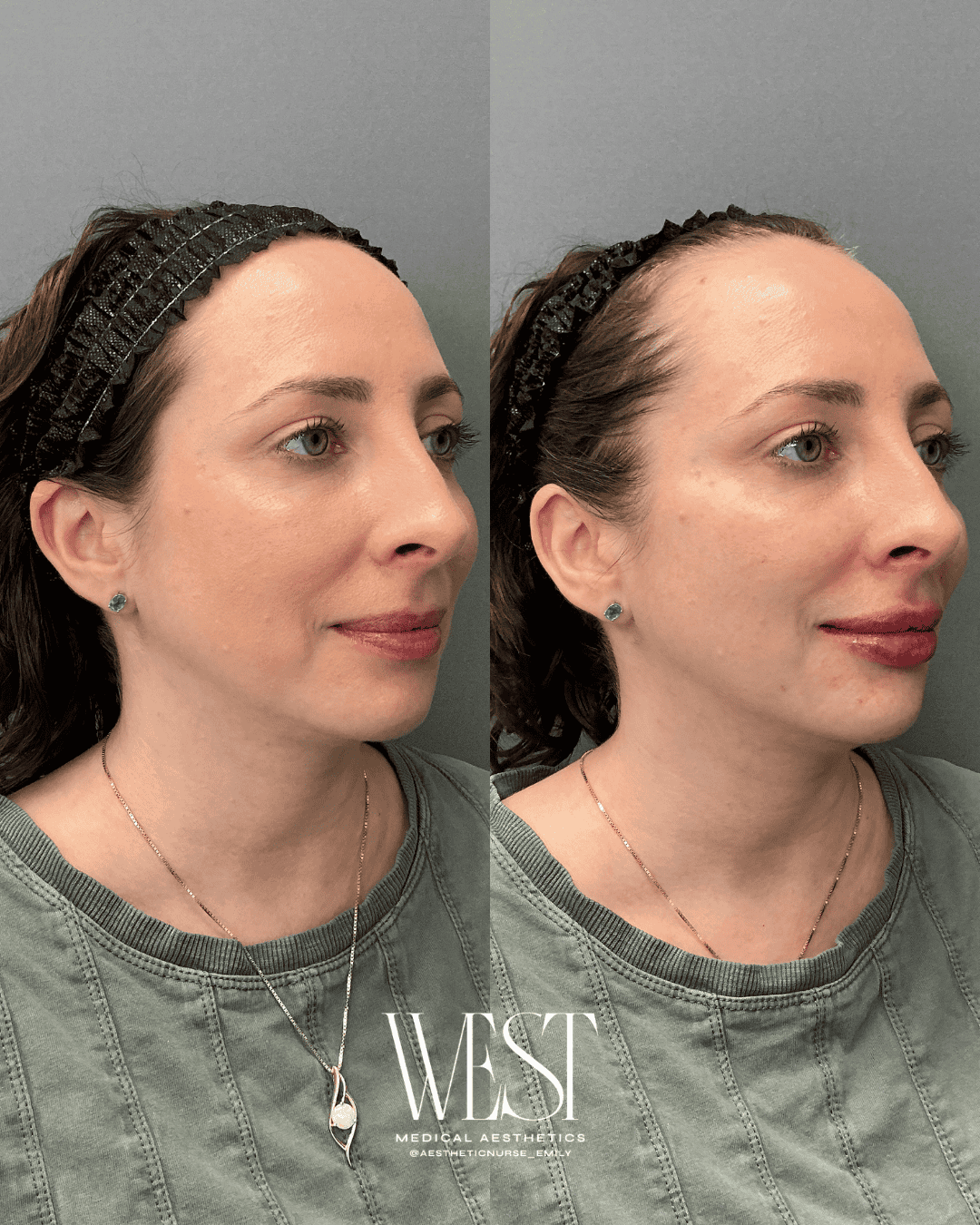 best lip filler in oklahoma city