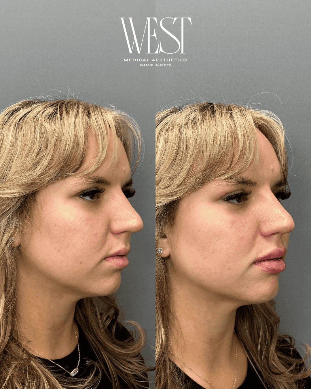 best lip filler in oklahoma city