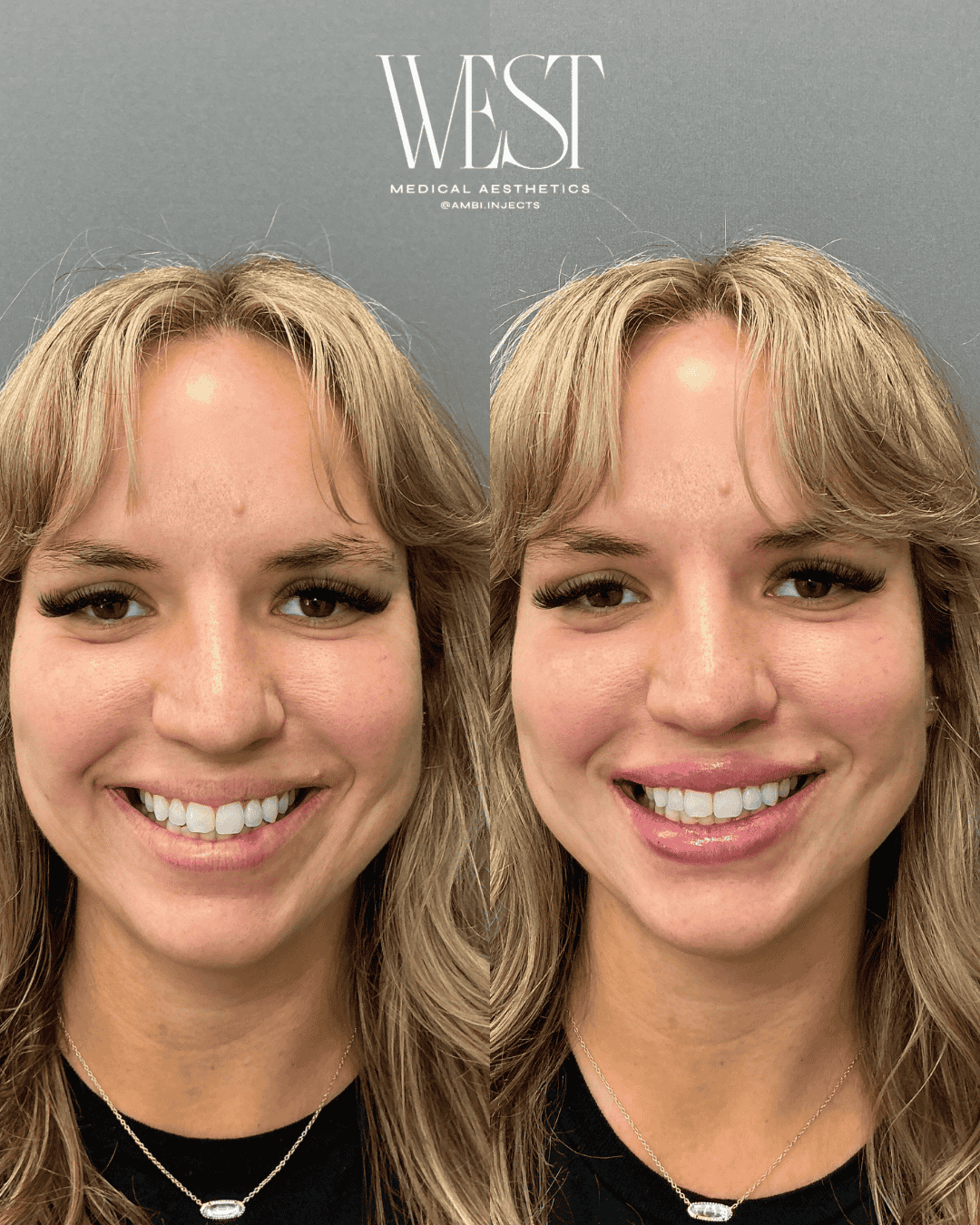 best lip filler in oklahoma city