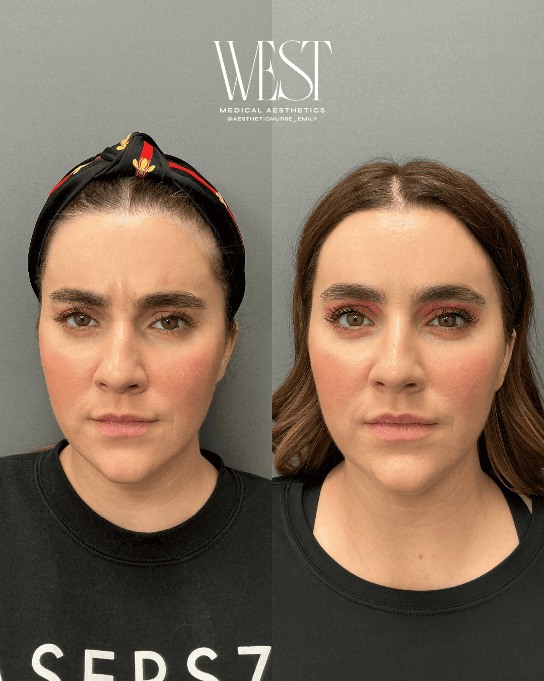 Daxxify Injectable in OKC