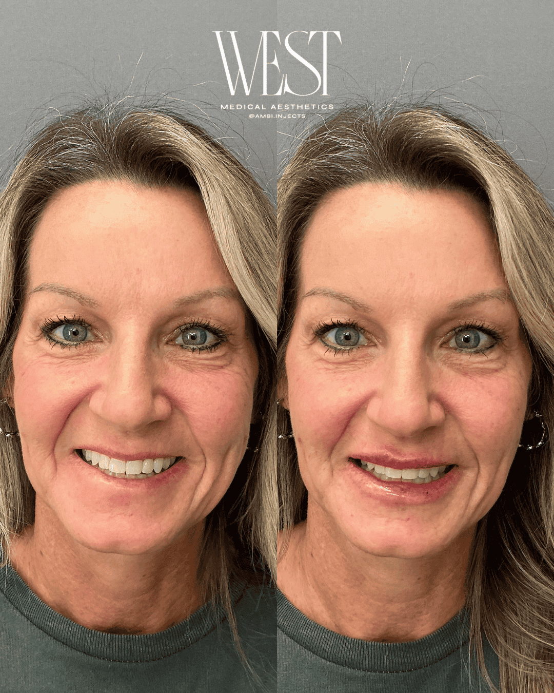 best lip filler in oklahoma city