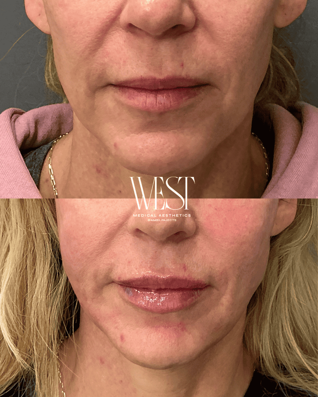 best lip filler in oklahoma city