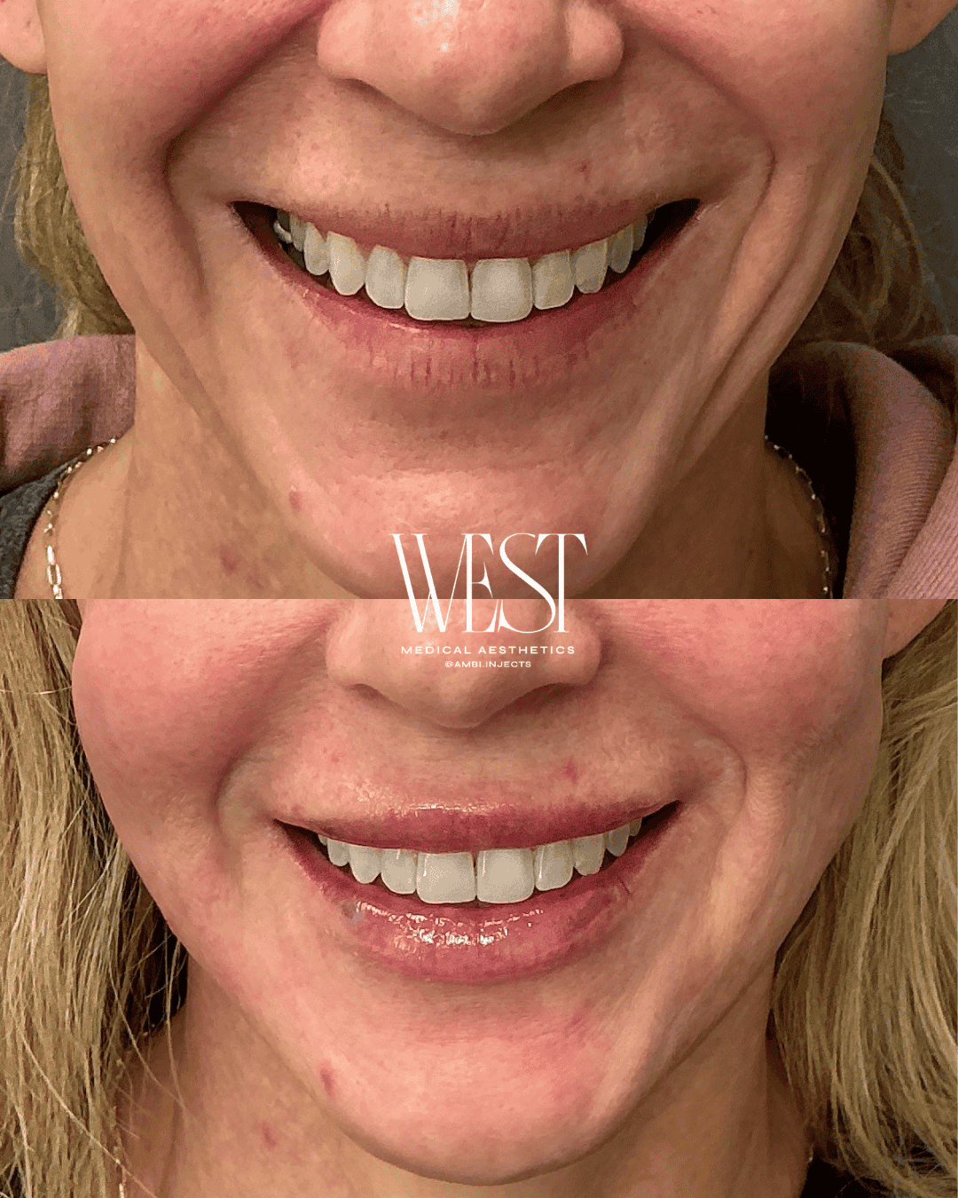 best lip filler in oklahoma city