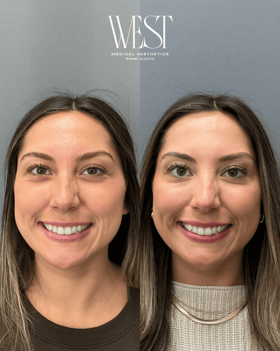 Dysport injectables in OKC
