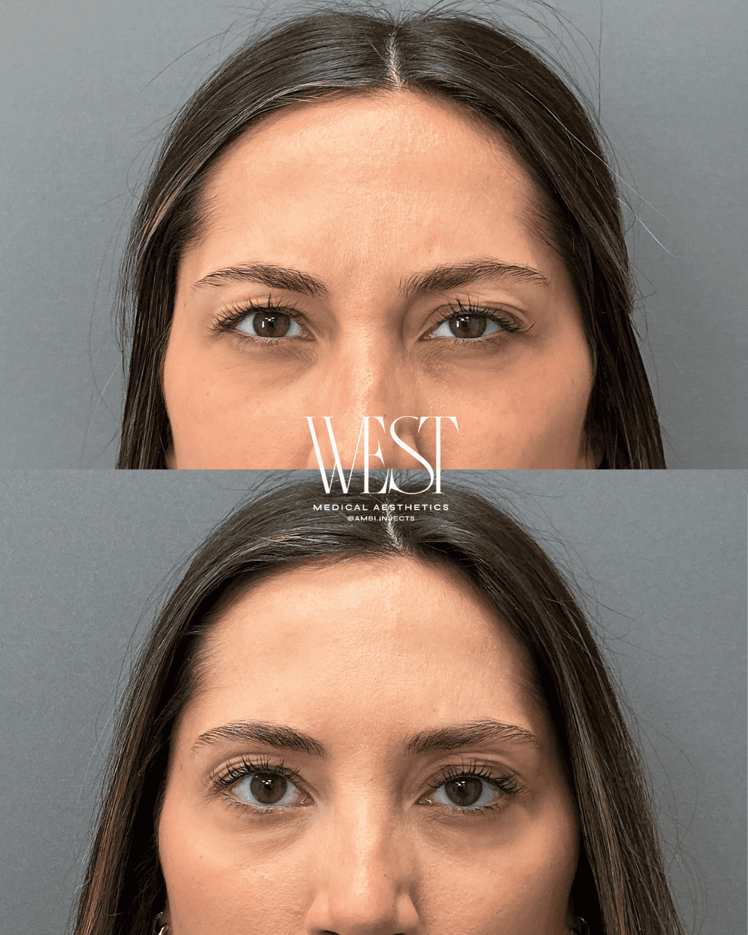 Dysport botox in OKC