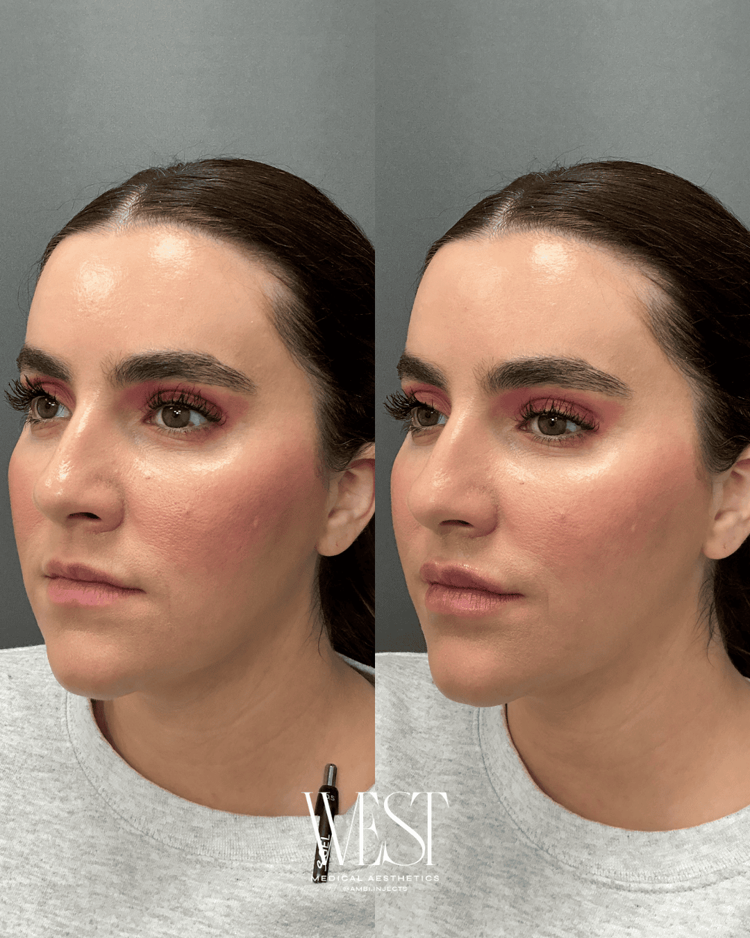 best lip filler in oklahoma city