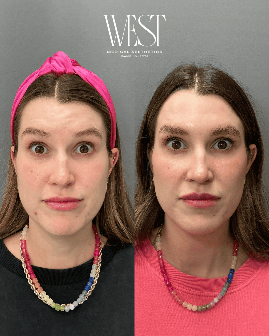 Daxxify botox in OKC
