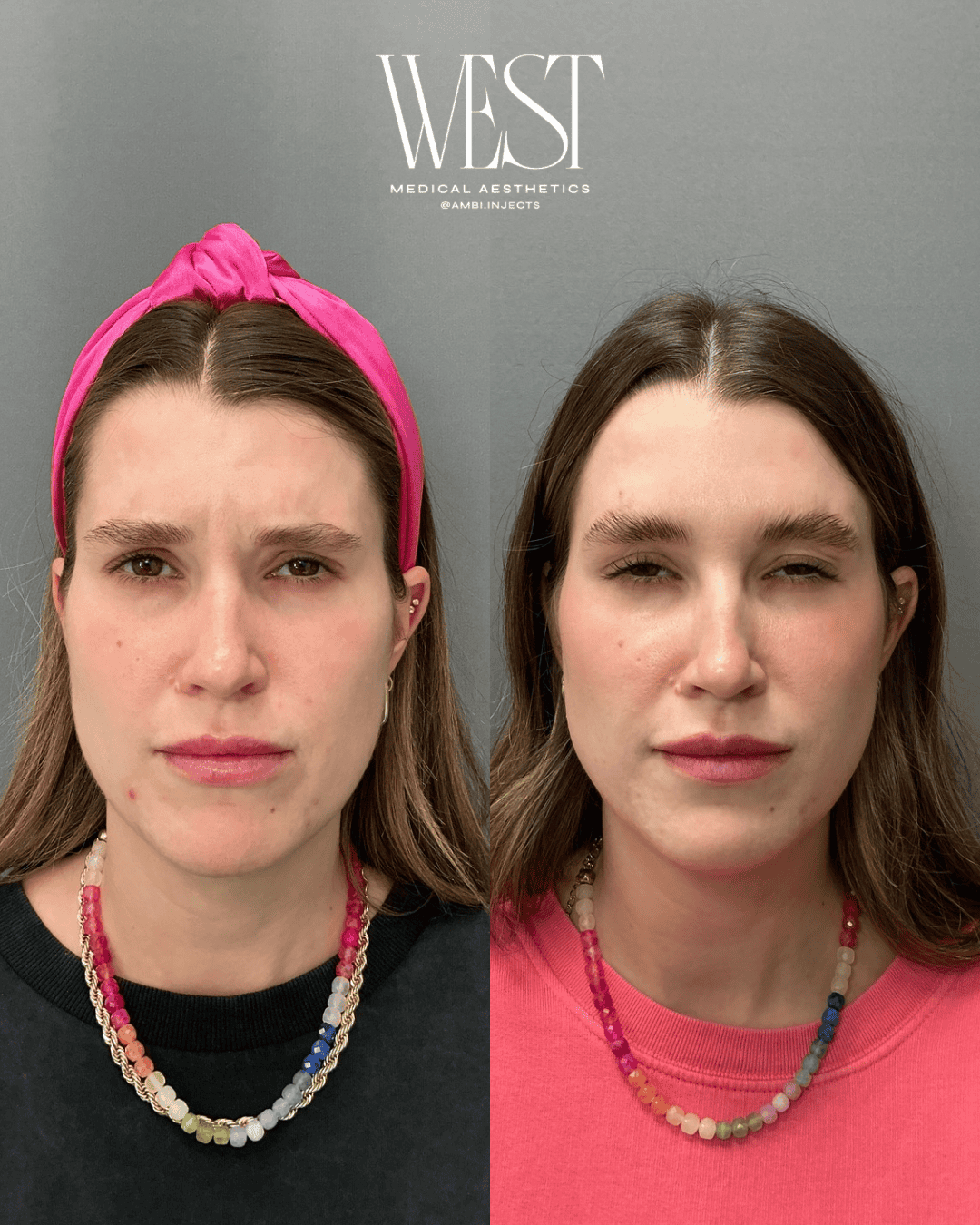 Daxxify botox in OKC