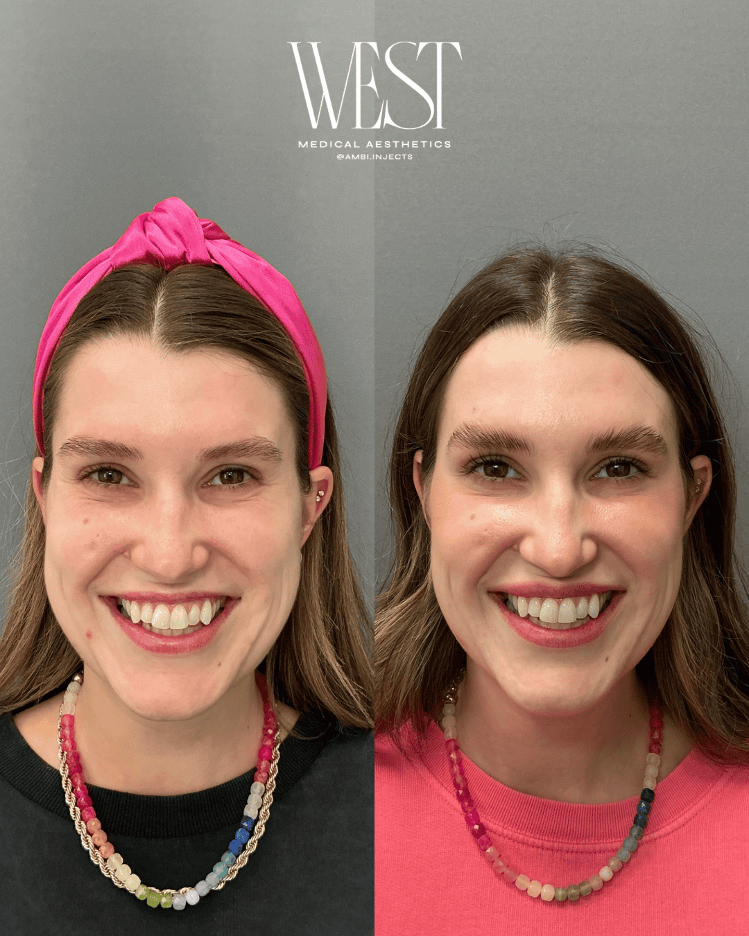 Daxxify botox in OKC