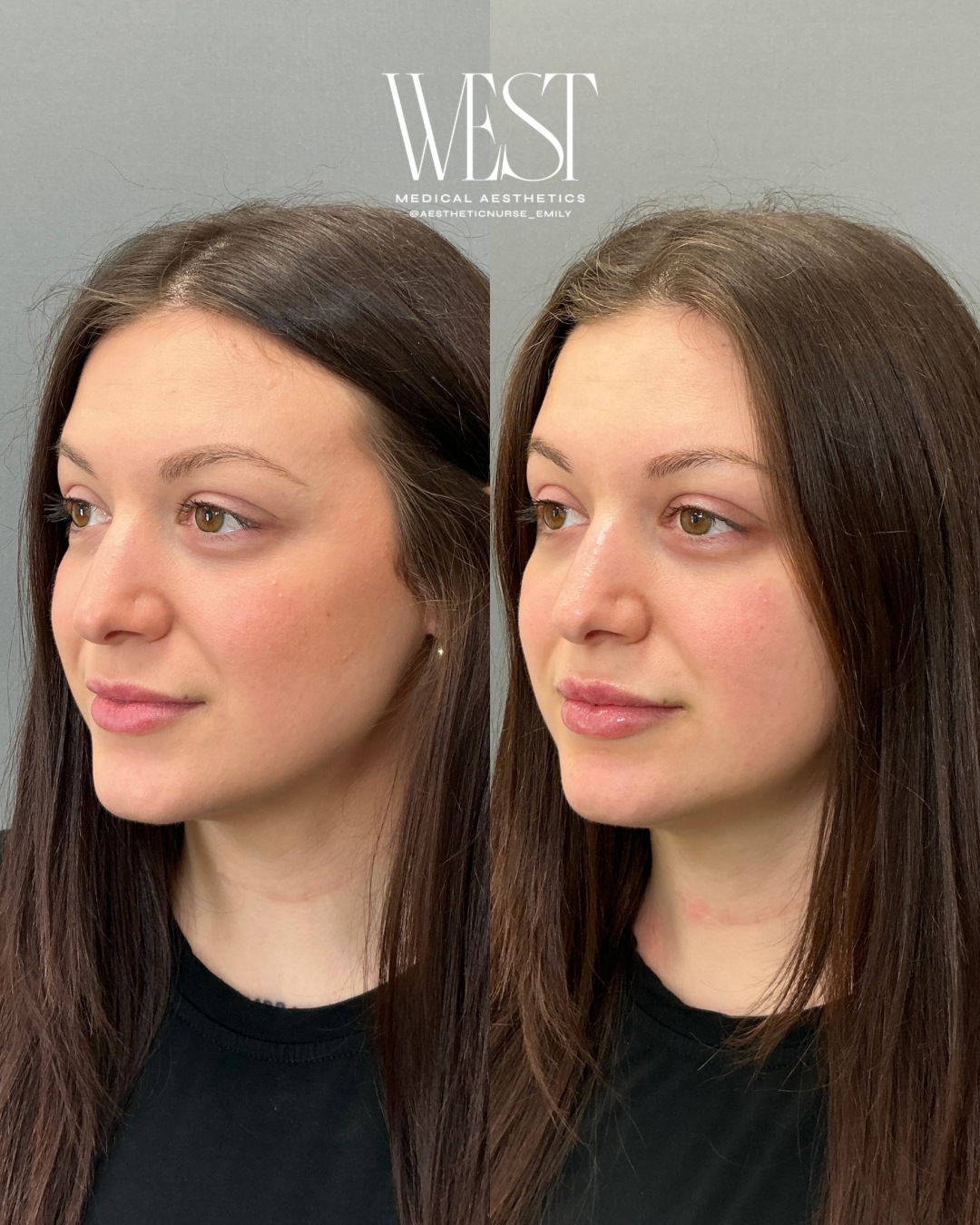 Side-by-side comparison of a woman's face before and after cosmetic treatment, showing improved skin texture and contour.