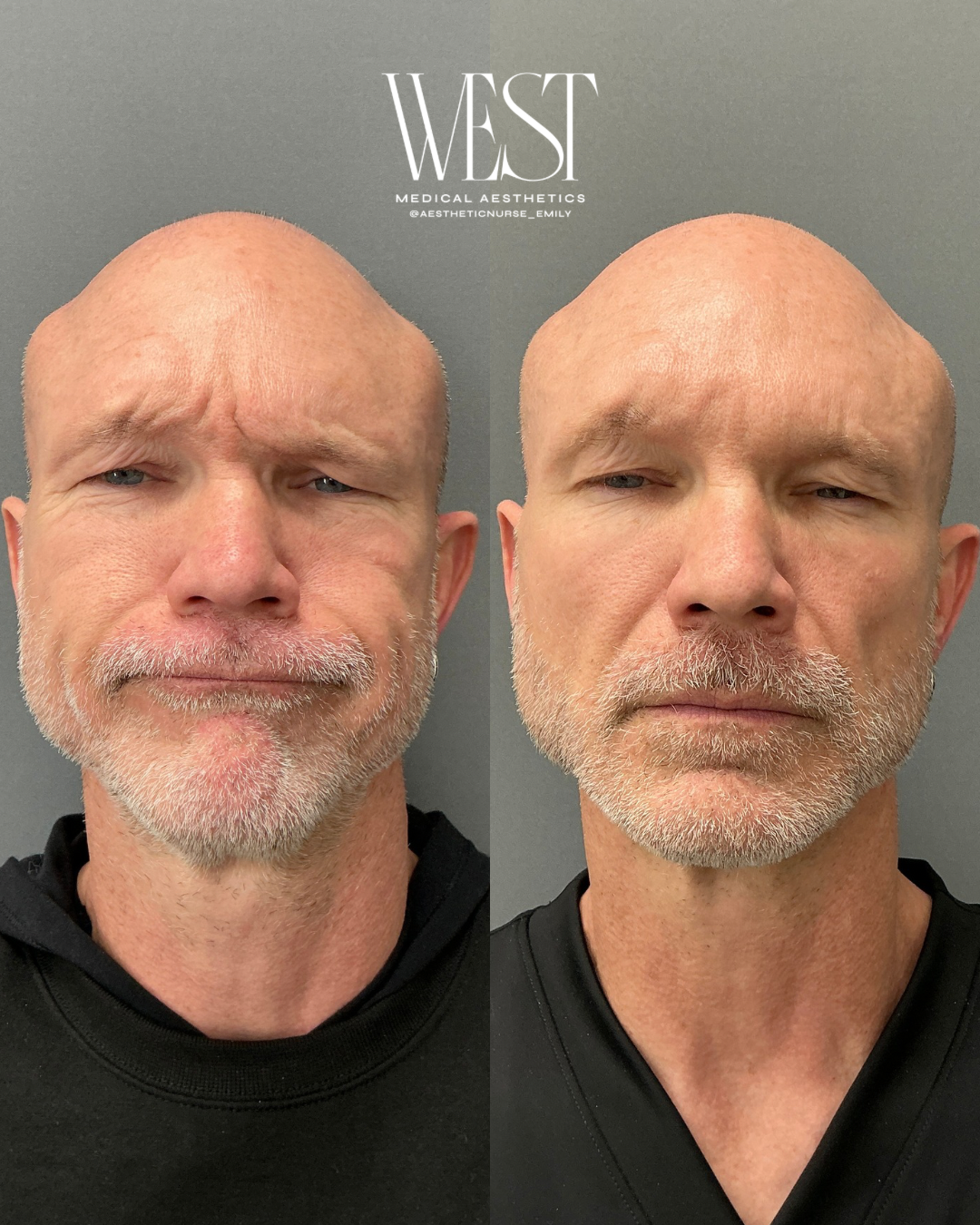 Side-by-side comparison of a middle-aged man before and after a cosmetic procedure, showing changes in facial appearance, including reduced wrinkles and a smoother skin texture.
