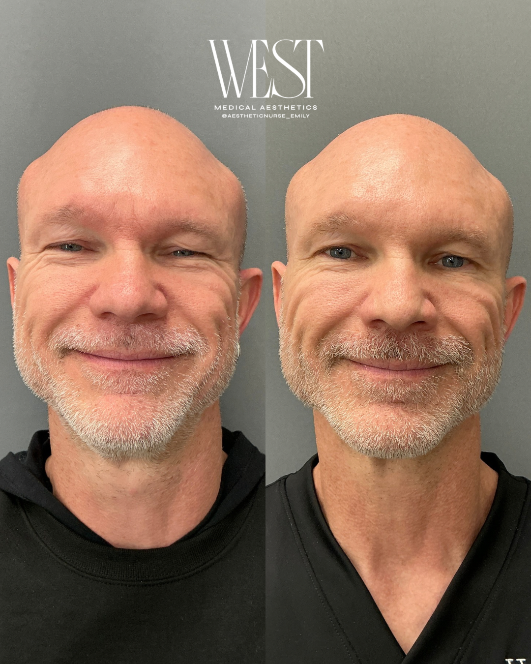 Before and after comparison of a man's face showing improved skin texture and tone following a cosmetic treatment, with the word 'WEST' and medical aesthetics contact information at the top.
