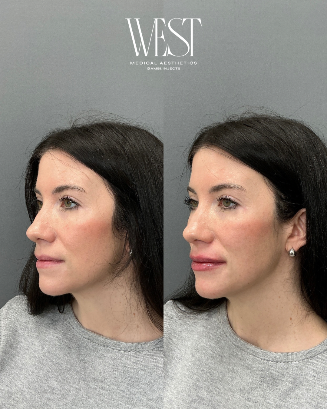 Before and after side-by-side comparison of a woman's face showing cosmetic enhancements, with the logo 'WEST Medical Aesthetics' at the top.