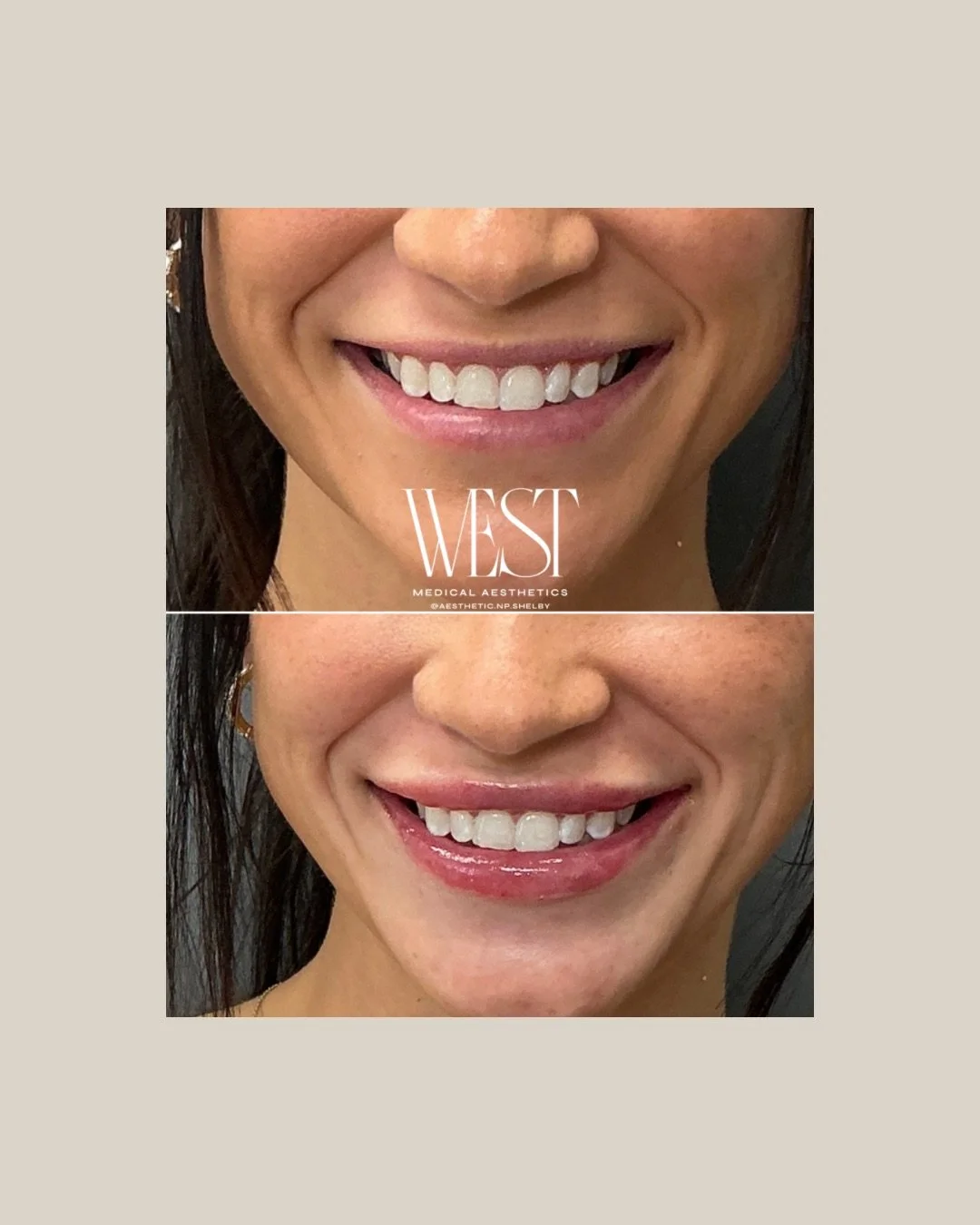 Before + After | Lip Filler

A subtle refresh focused on enhancing her natural lip shape while adding soft volume and definition.

The result? Fuller, more balanced lips that still feel completely natural to her features.

Freshly treated, so some sw