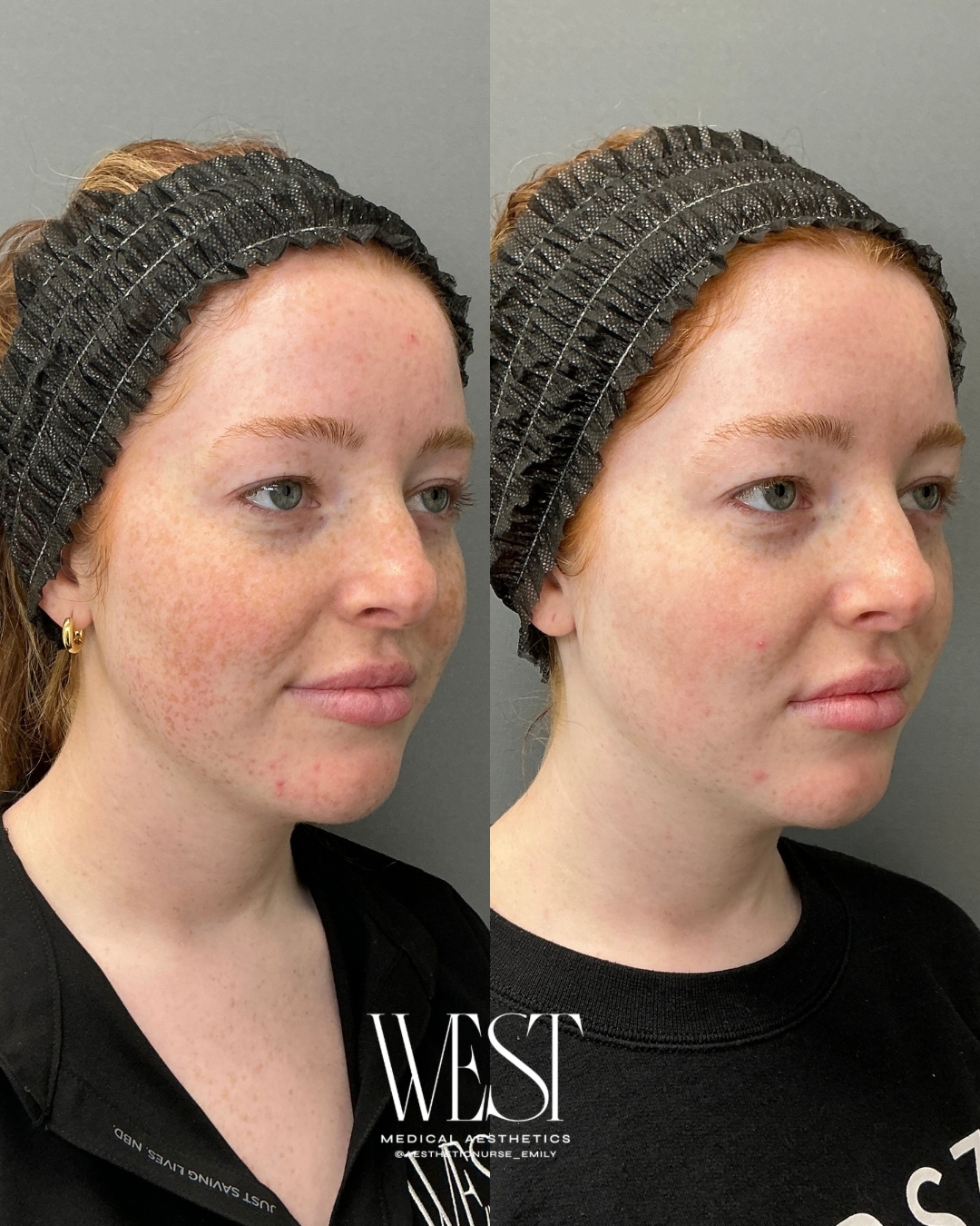 BBL Laser Treatment before and after in OKC