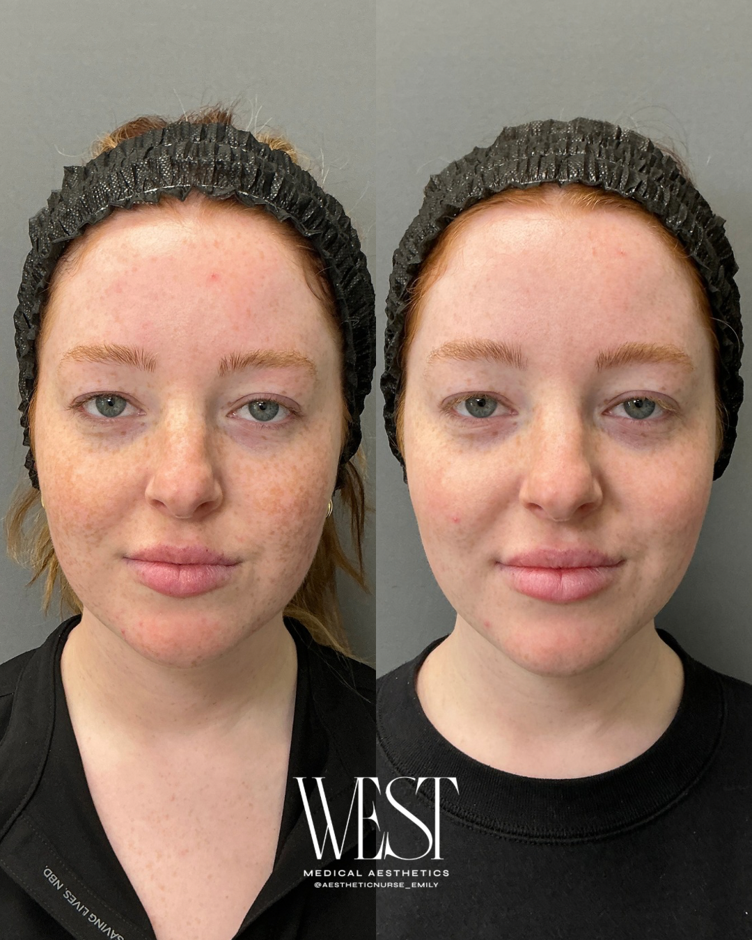 BBL Laser Treatment before and after in OKC