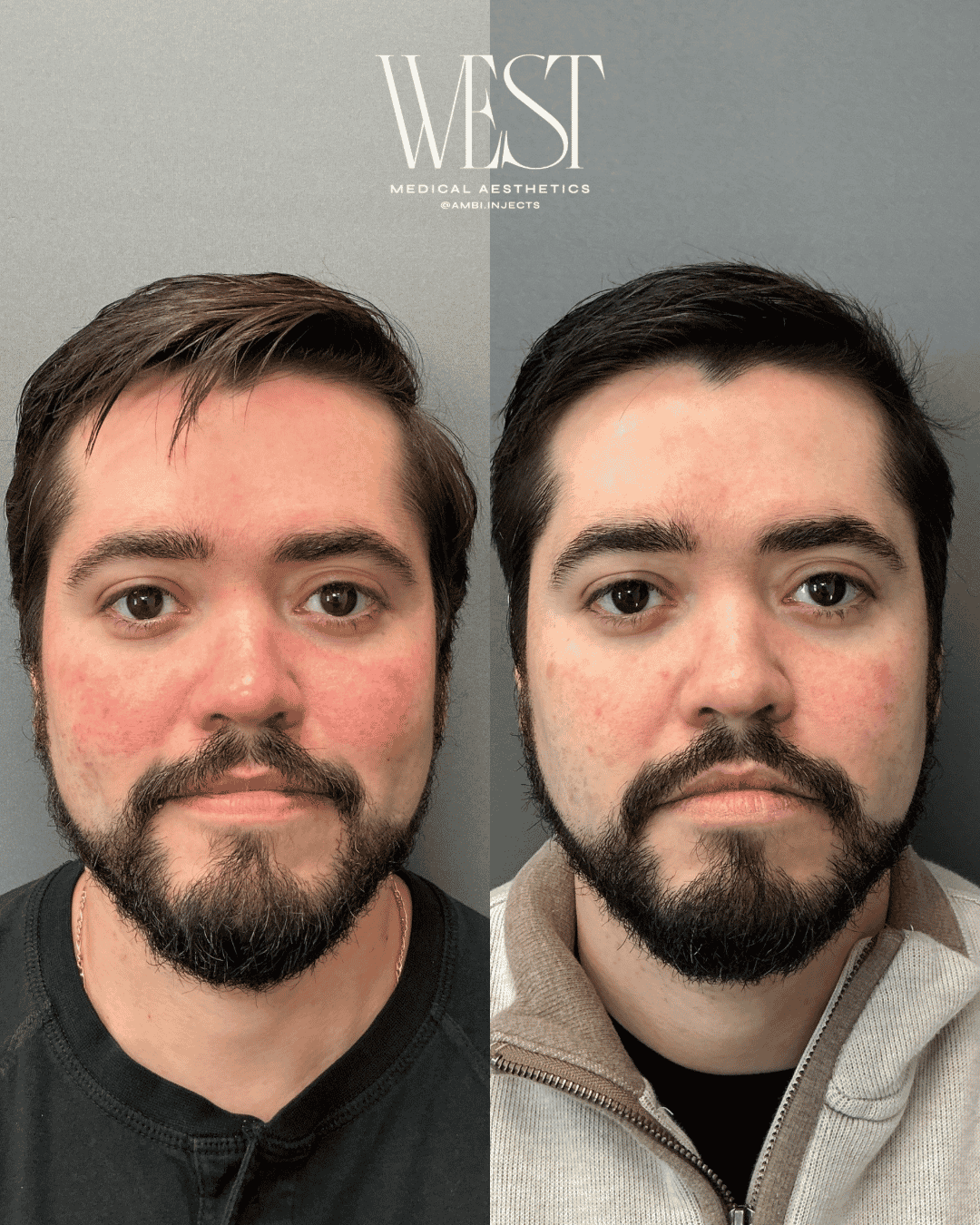 Mens Laser skin treatment in okc