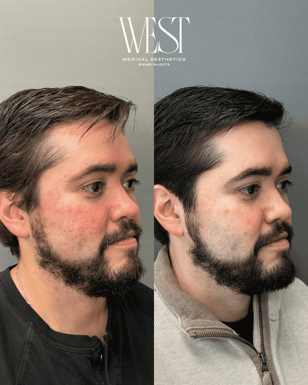 Mens Laser skin treatment in okc