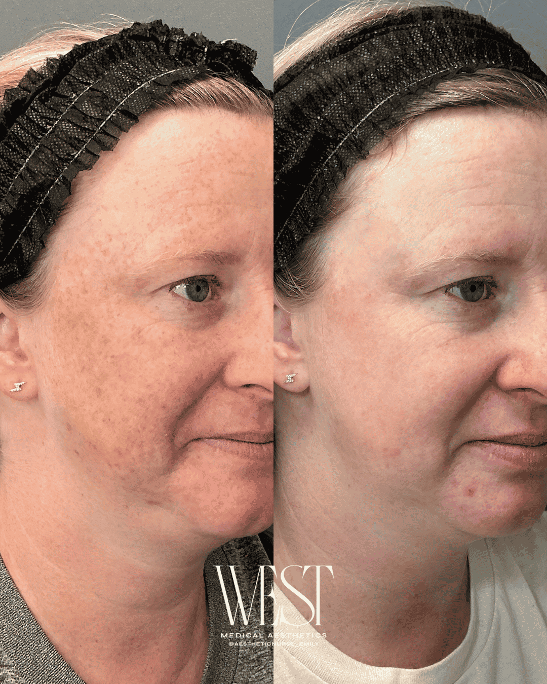 BBL Moxi laser skin treatment in OKC