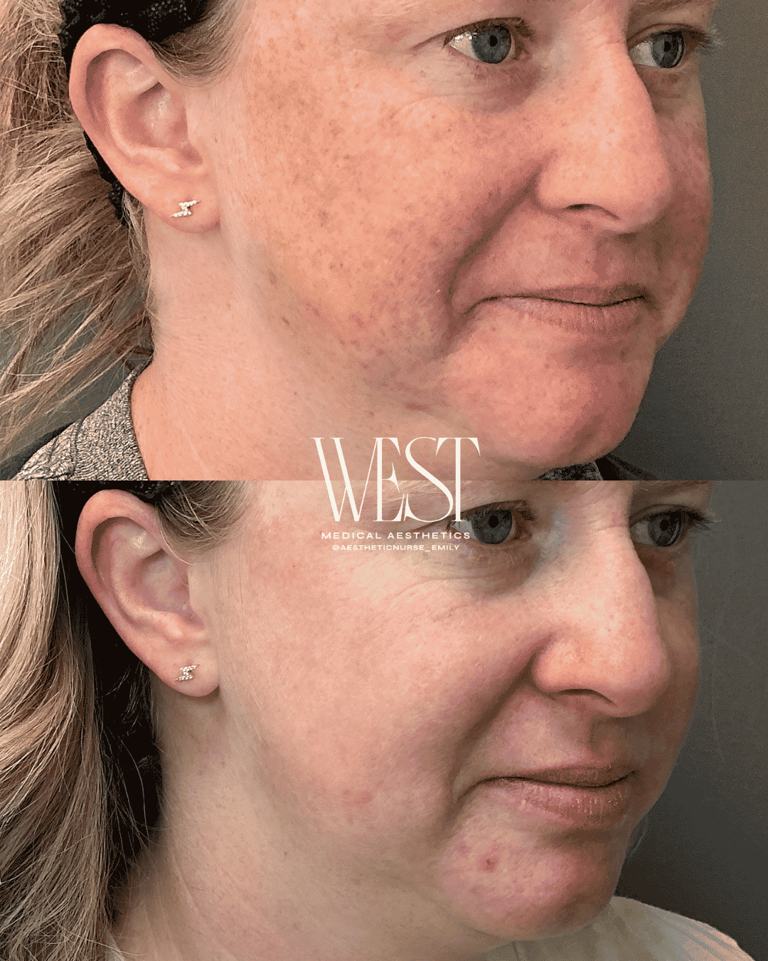 BBL Moxi laser skin treatment in OKC