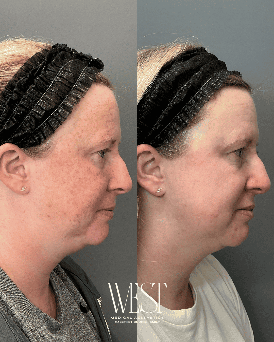 Side-by-side comparison of a woman's face before and after a cosmetic treatment, showing reduced redness and improved skin texture. The woman is wearing a black hair cover in both images and has a small earring.