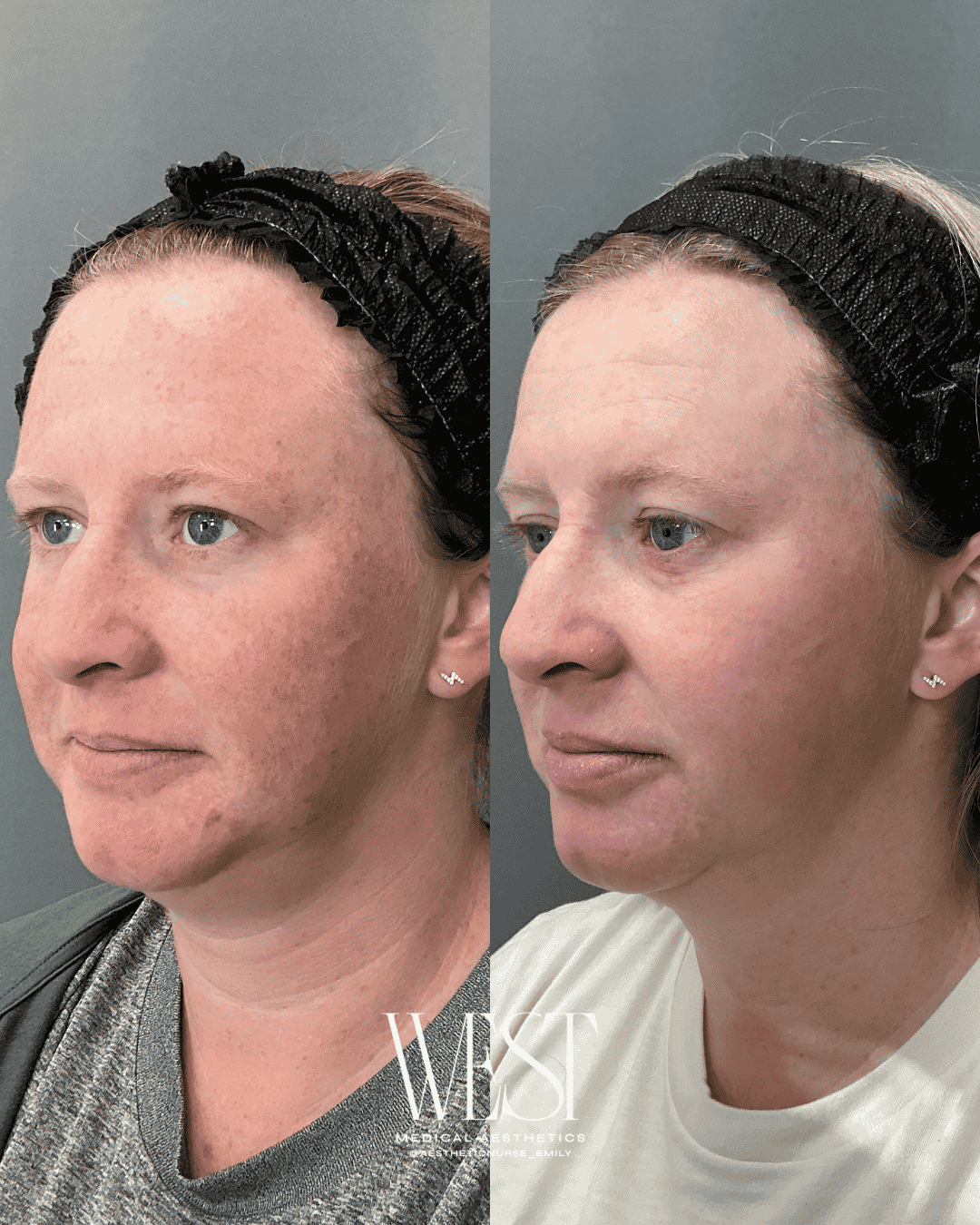 Laser skin treatment before and after in OKC