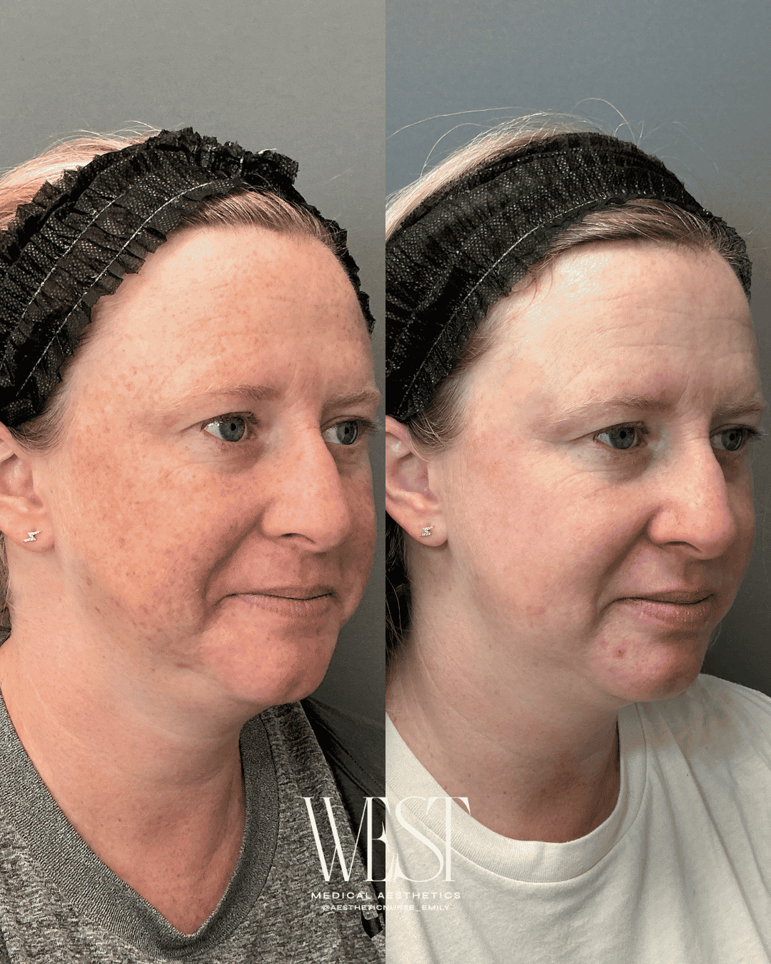 BBL Moxi laser skin treatment in OKC