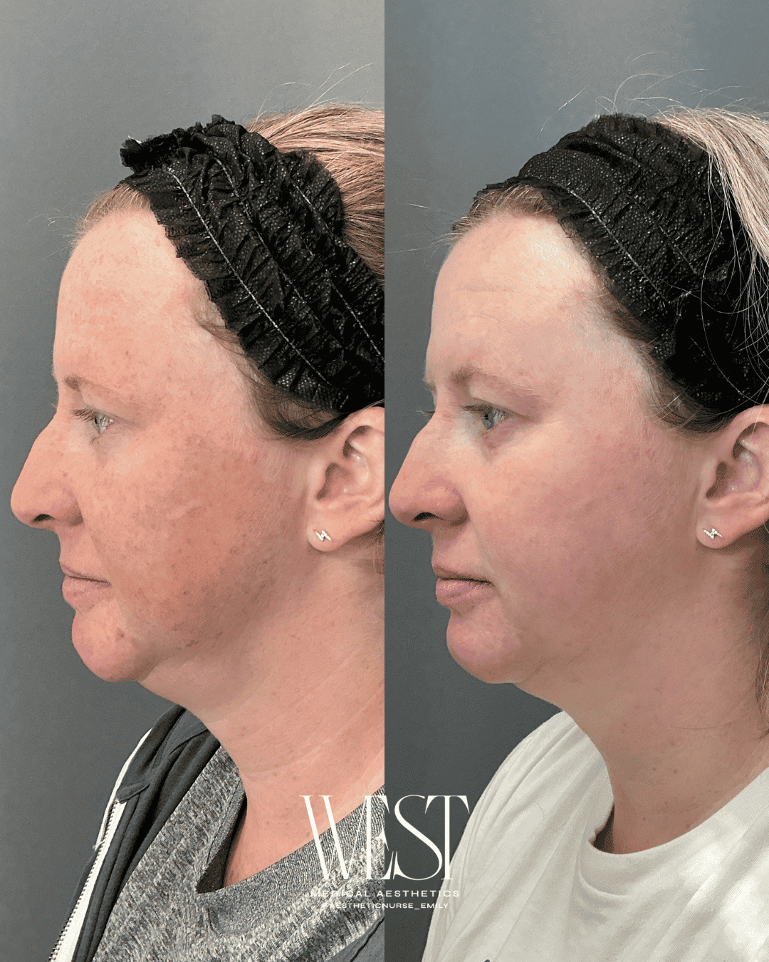 BBL Moxi laser skin treatment in OKC