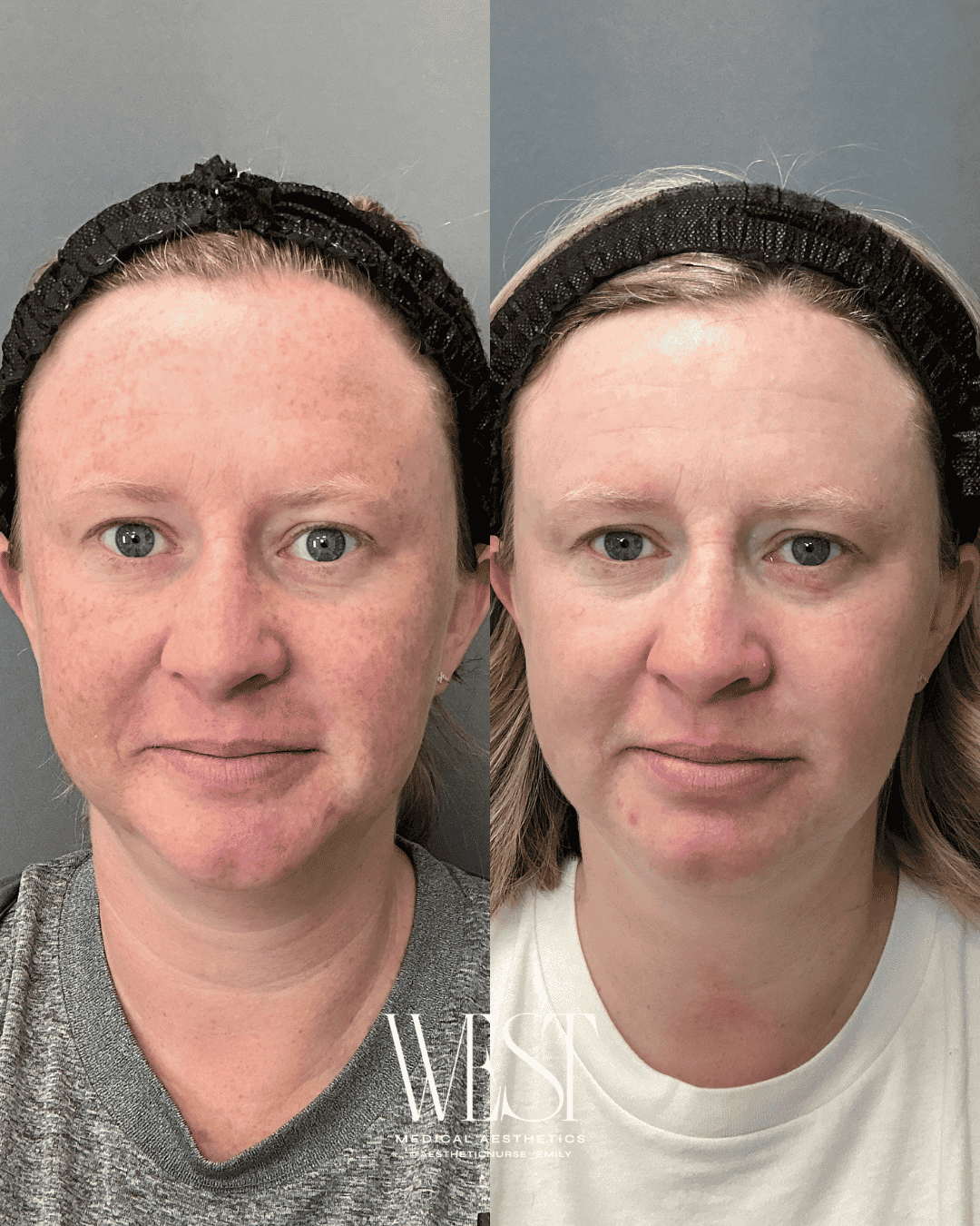 BBL Moxi laser skin treatment in OKC