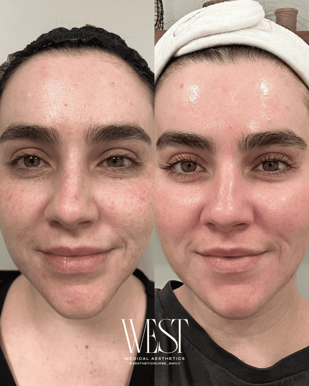 Laser skin treatment in okc
