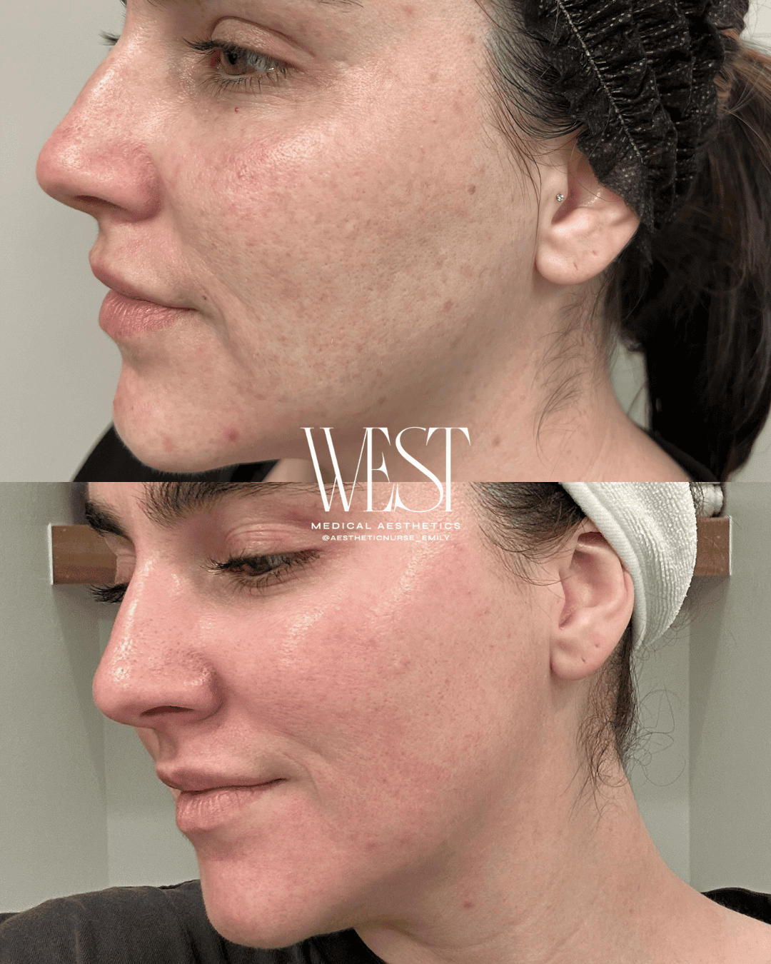 Moxi Laser skin treatment in okc
