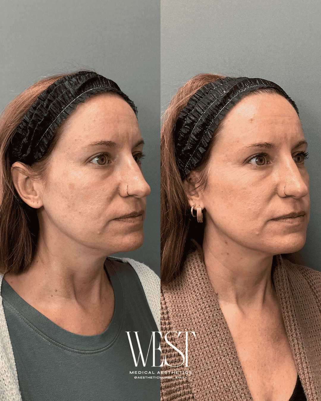 Laser skin treatment before and after in OKC