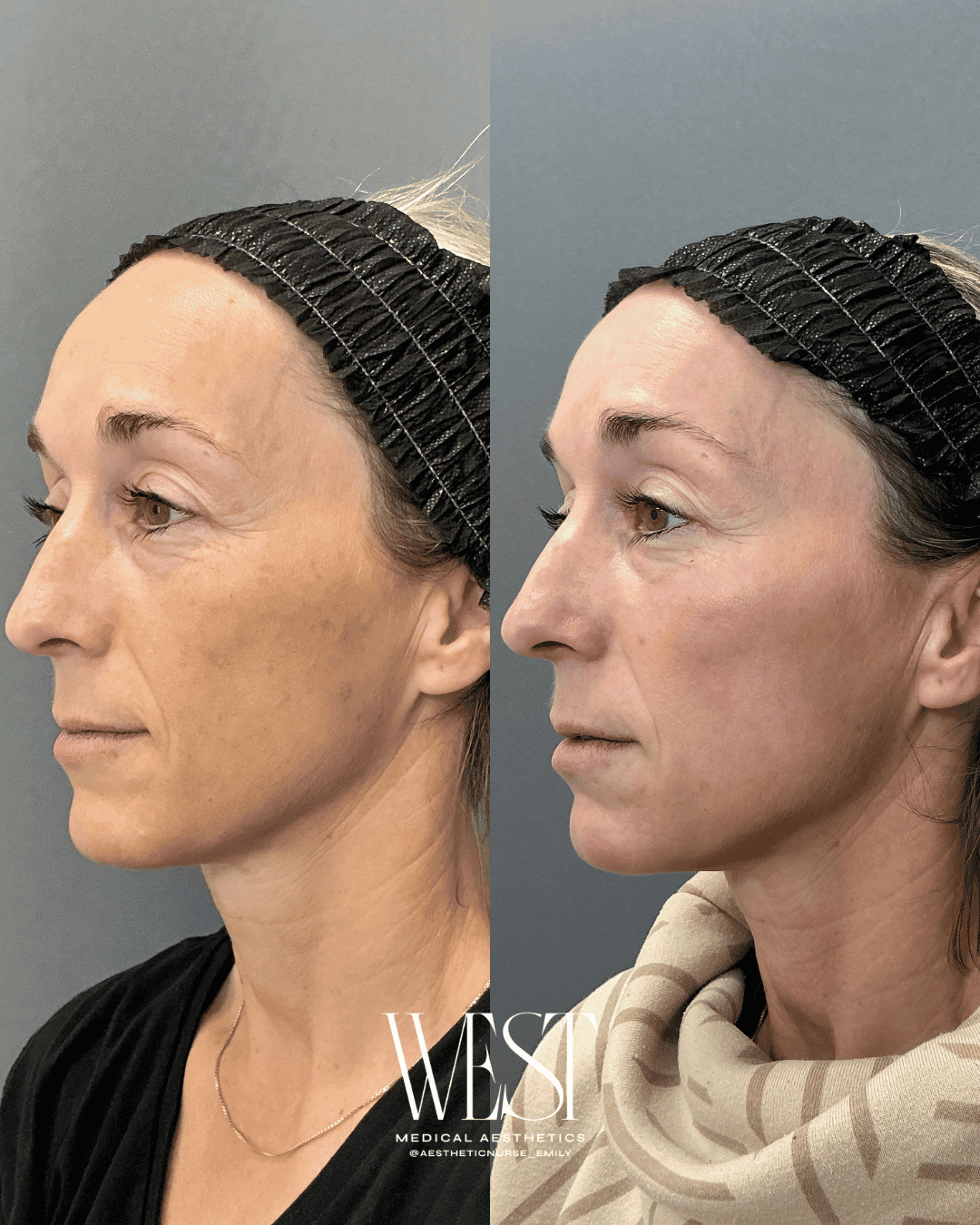 Laser skin treatment in okc