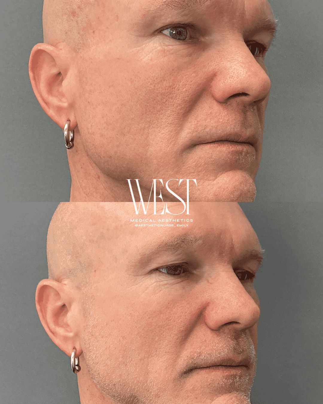 Mens. Laser skin treatment in okc