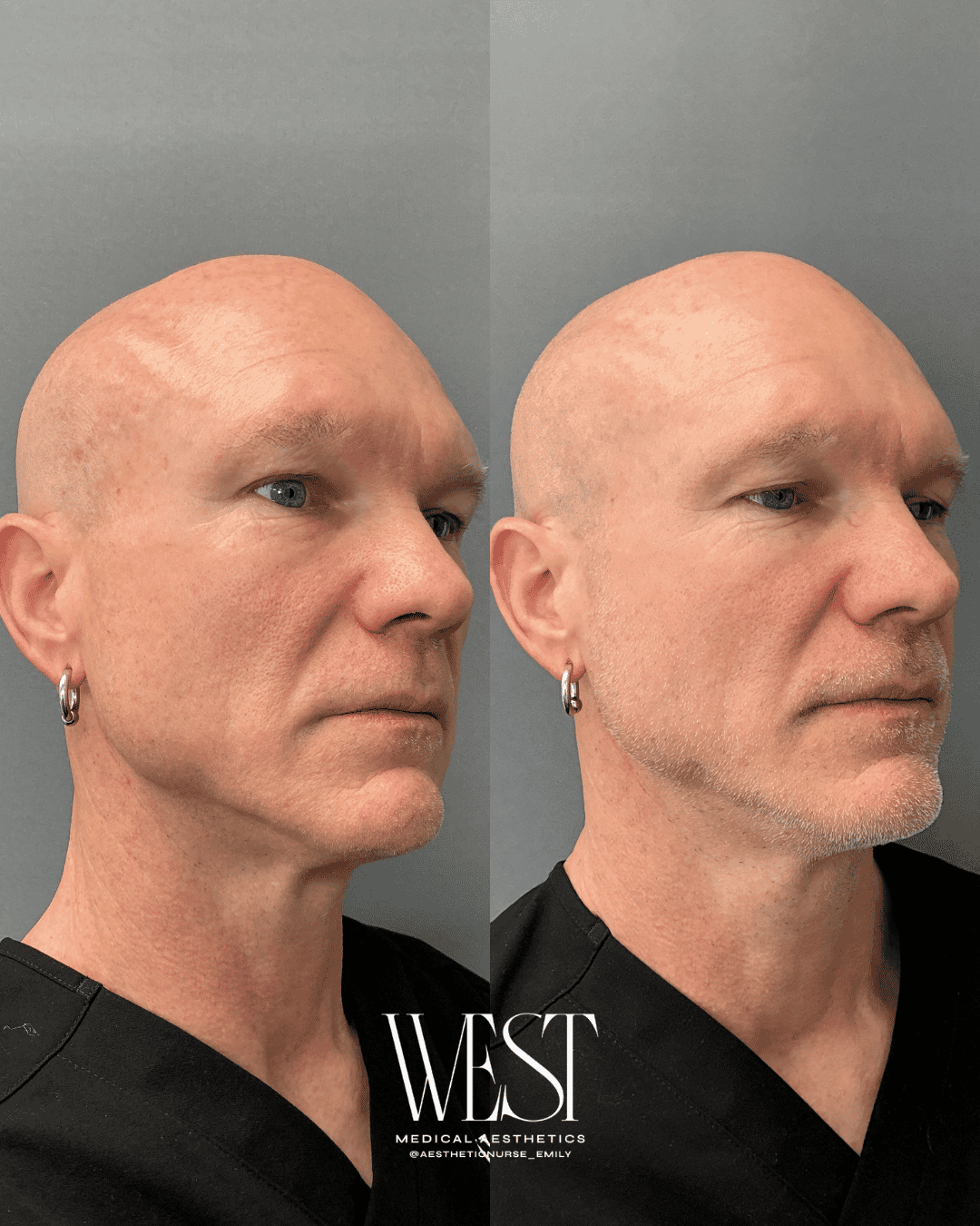 Mens Laser skin treatment in okc