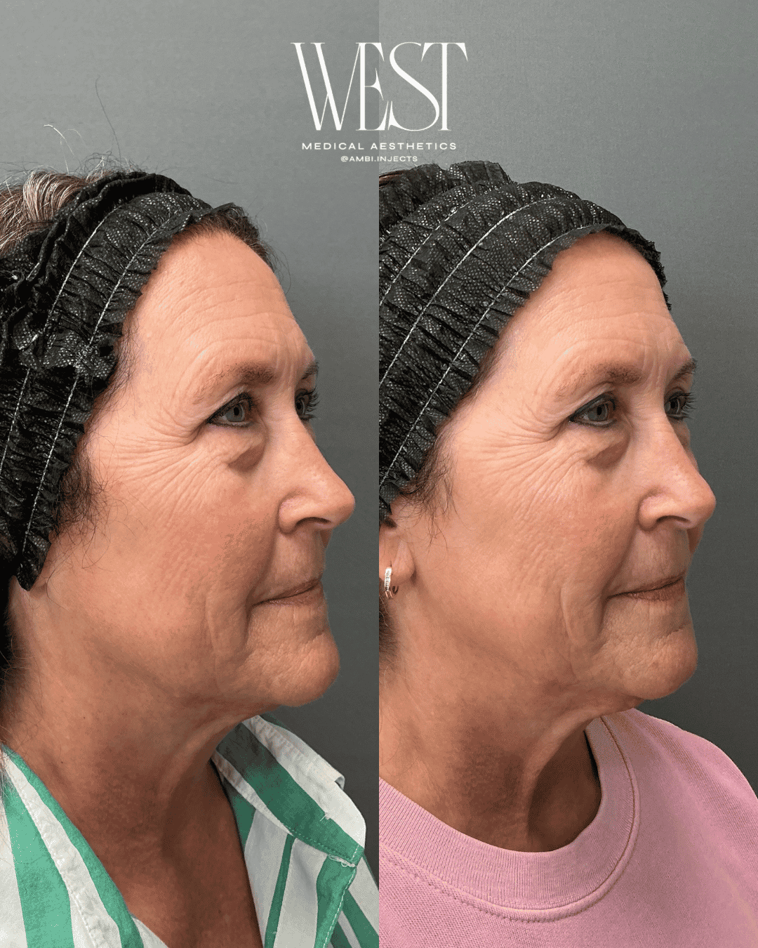 BBL Laser skin treatment in okc