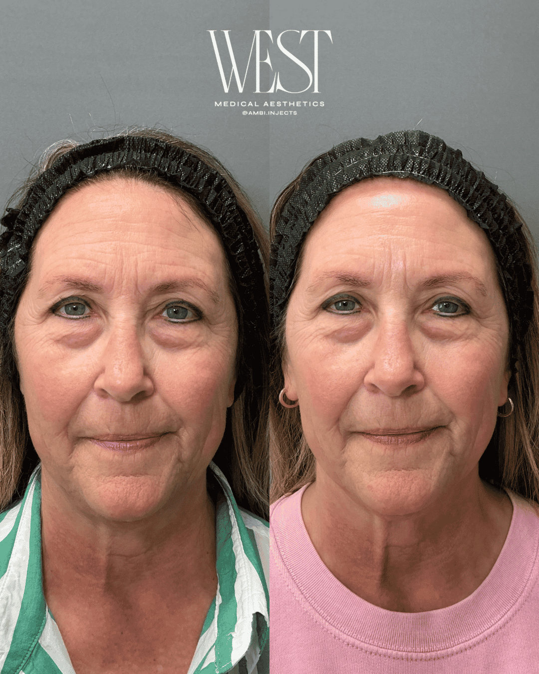 BBL Laser skin treatment in okc